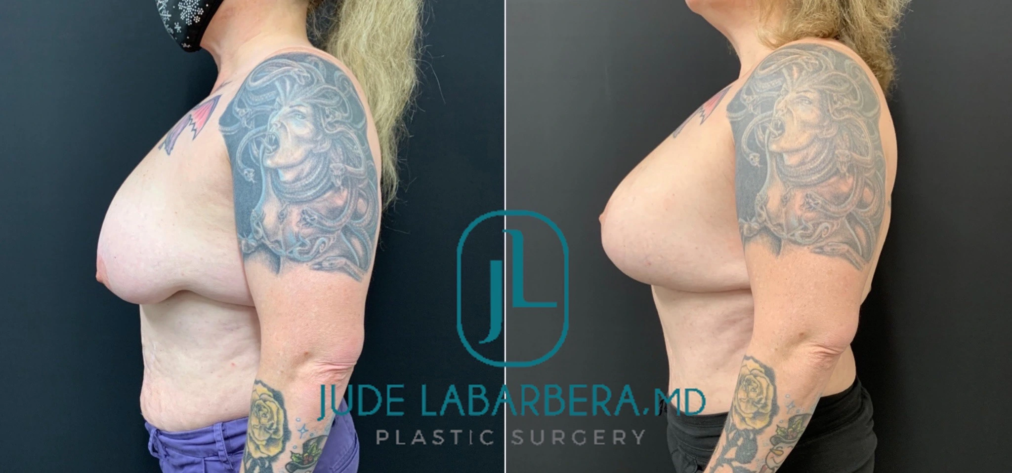 BREAST AUGMENTATION WITH LIFT Before & After Case Number 0003