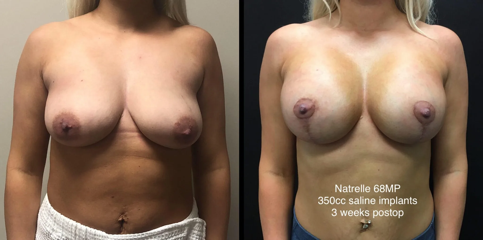 BREAST AUGMENTATION WITH LIFT Before & After Case Number 0006