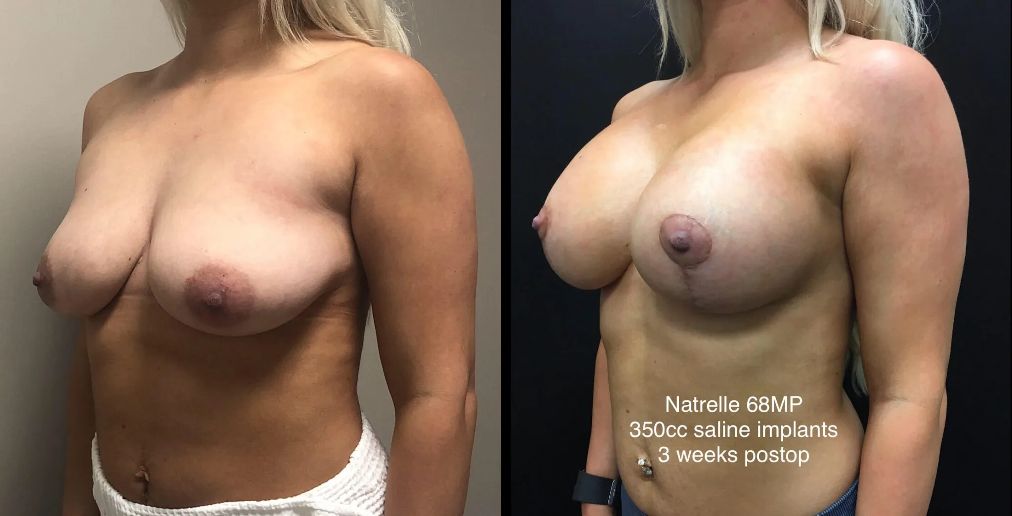 BREAST AUGMENTATION WITH LIFT Before & After Case Number 0006