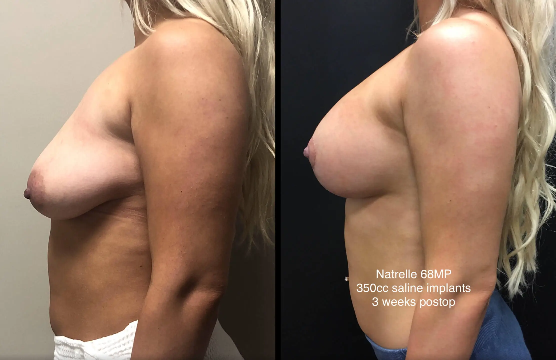 BREAST AUGMENTATION WITH LIFT Before & After Case Number 0006