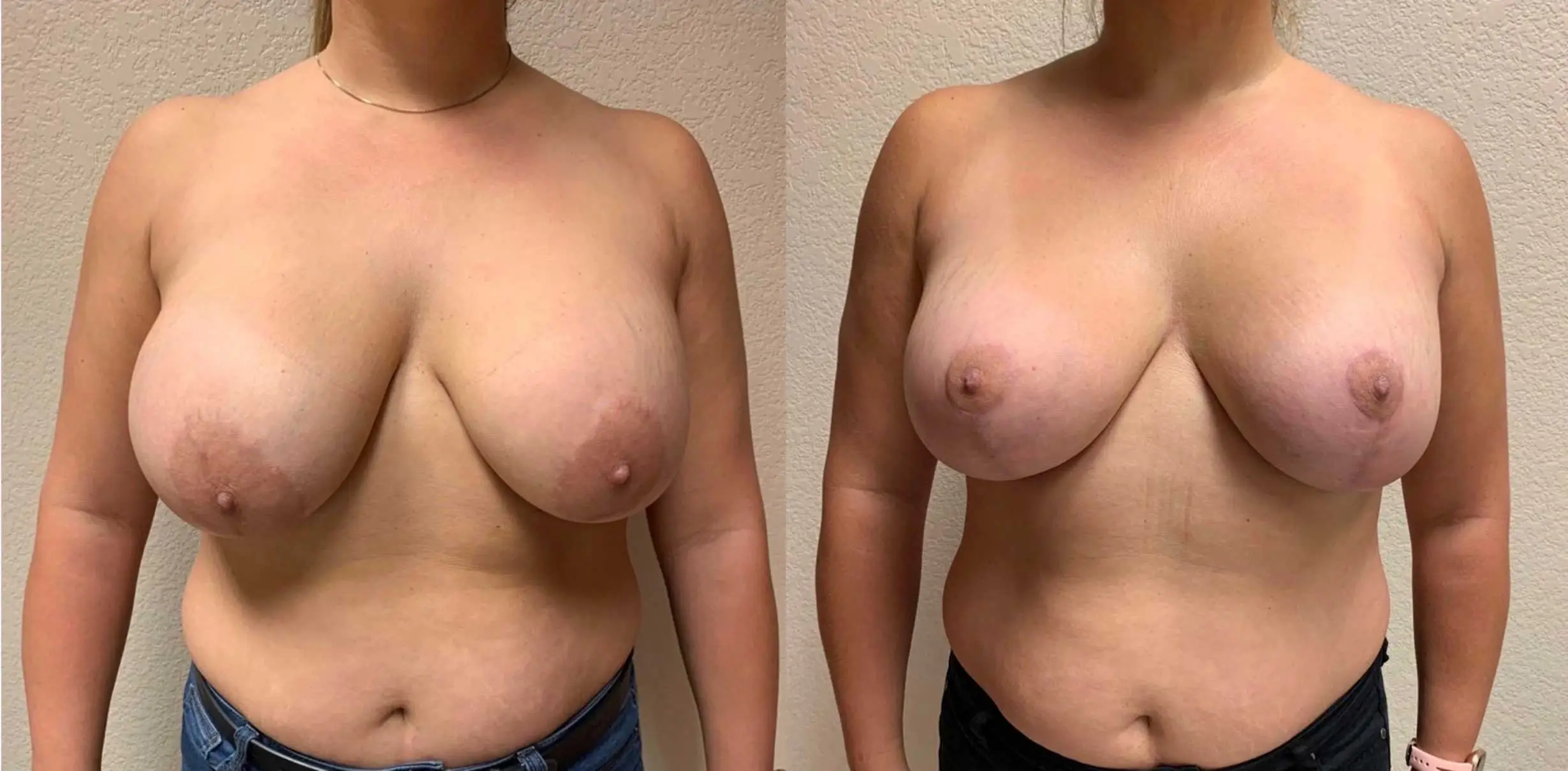 BREAST AUGMENTATION WITH LIFT Before & After Case Number 0006