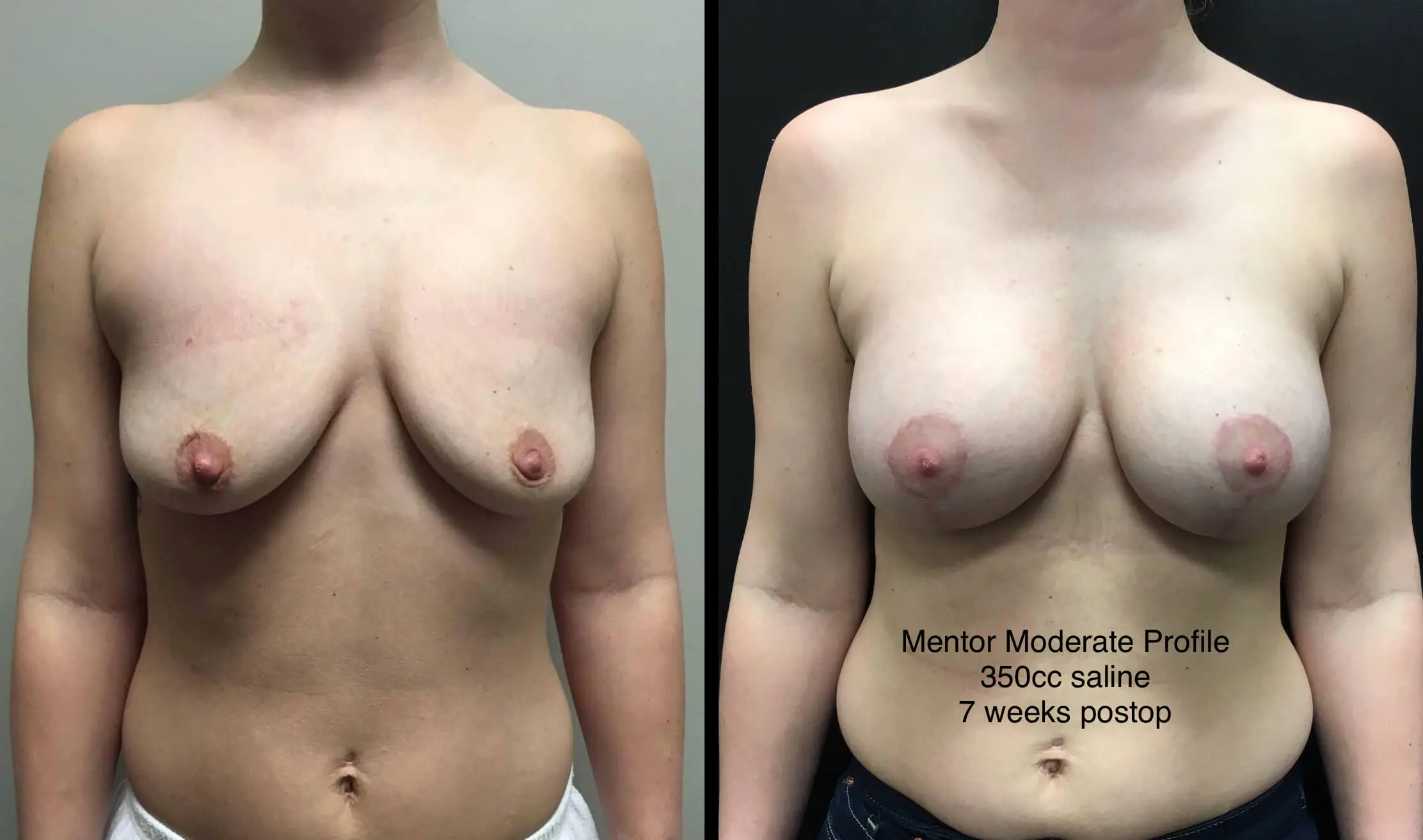 BREAST AUGMENTATION WITH LIFT Before & After Case Number 0008