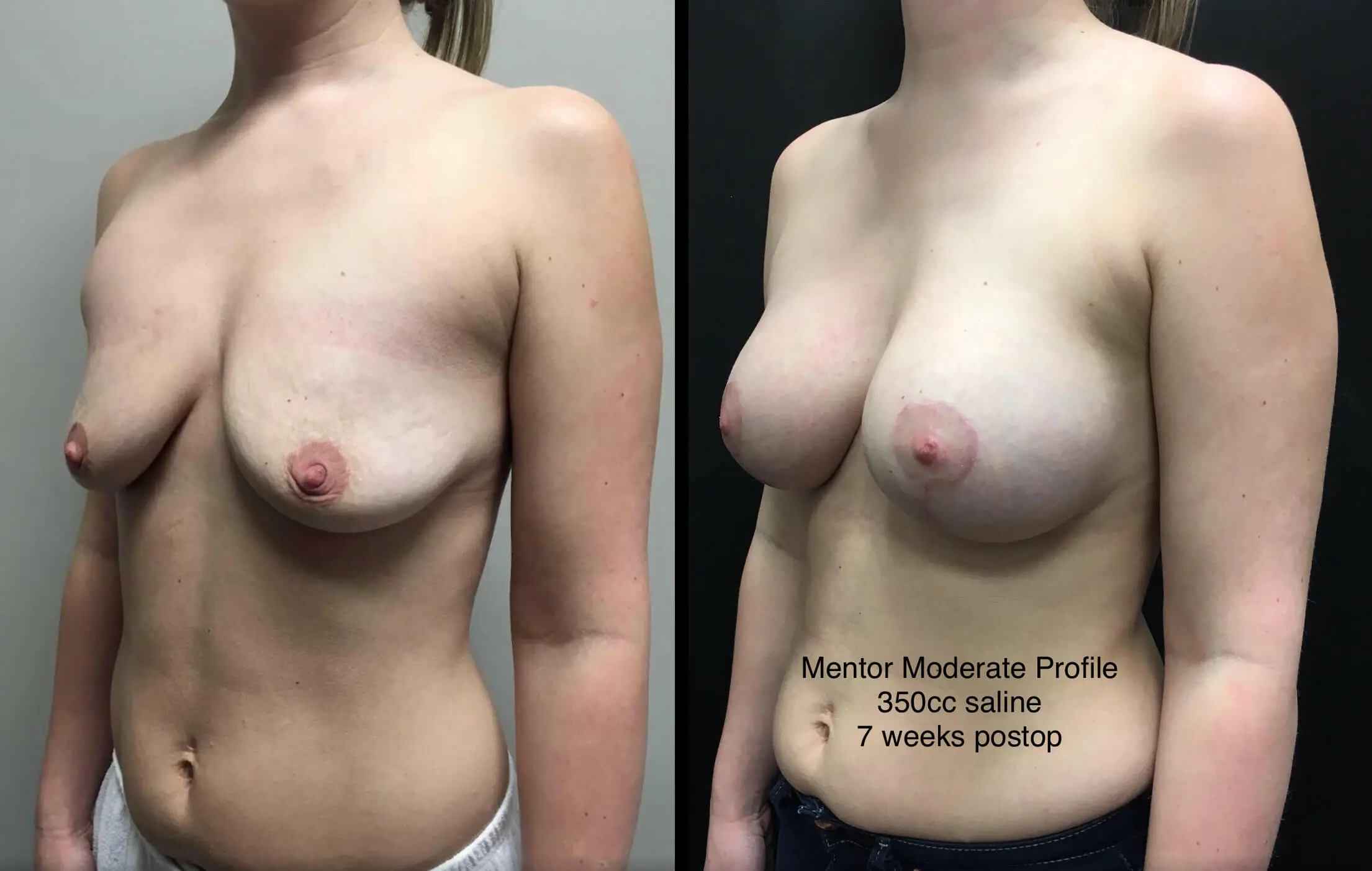 BREAST AUGMENTATION WITH LIFT Before & After Case Number 0008