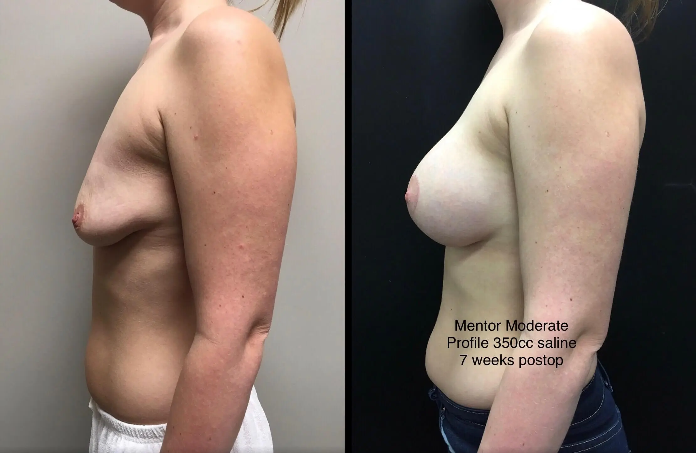 BREAST AUGMENTATION WITH LIFT Before & After Case Number 0008