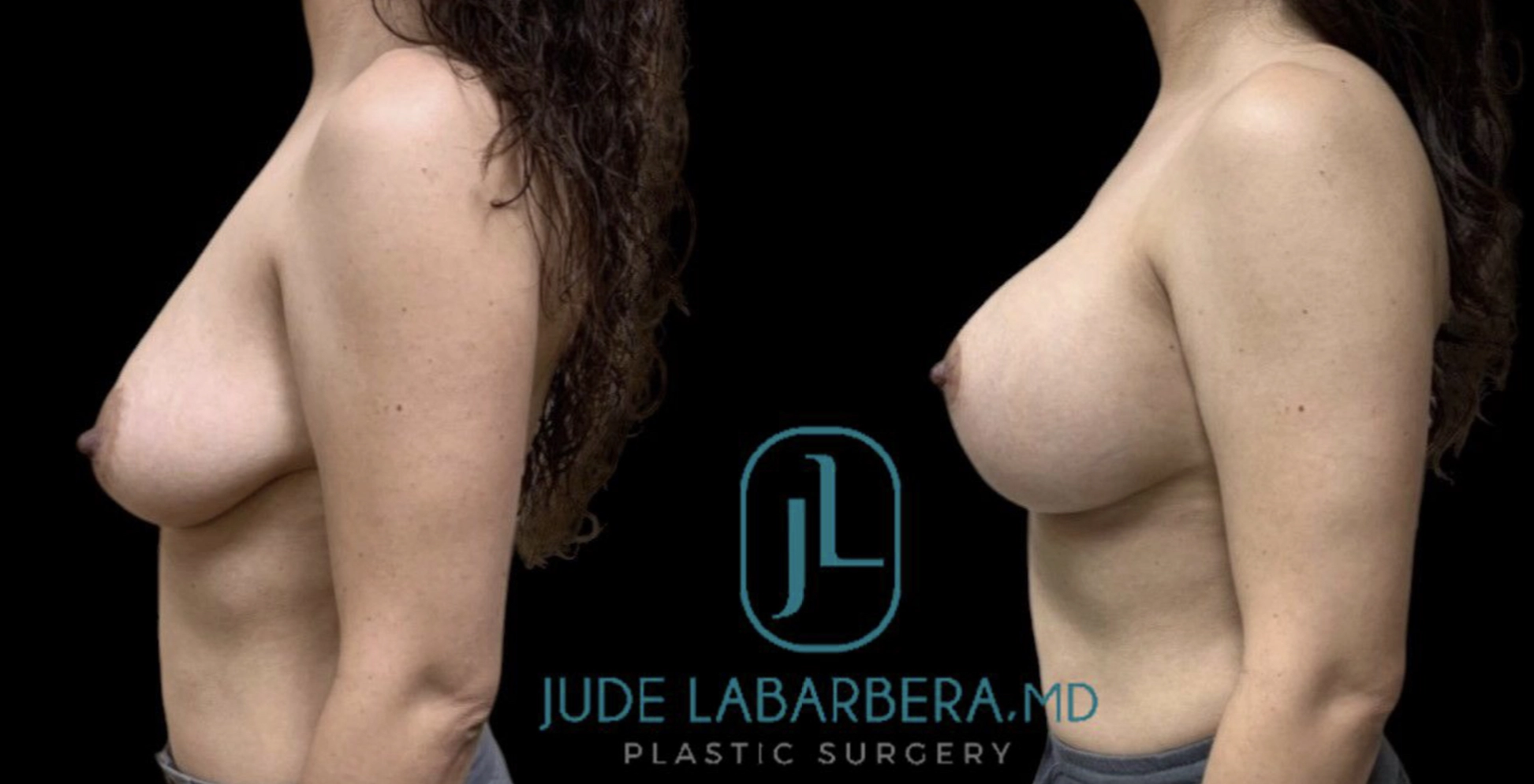 BREAST AUGMENTATION WITH LIFT Before & After Case Number 0009