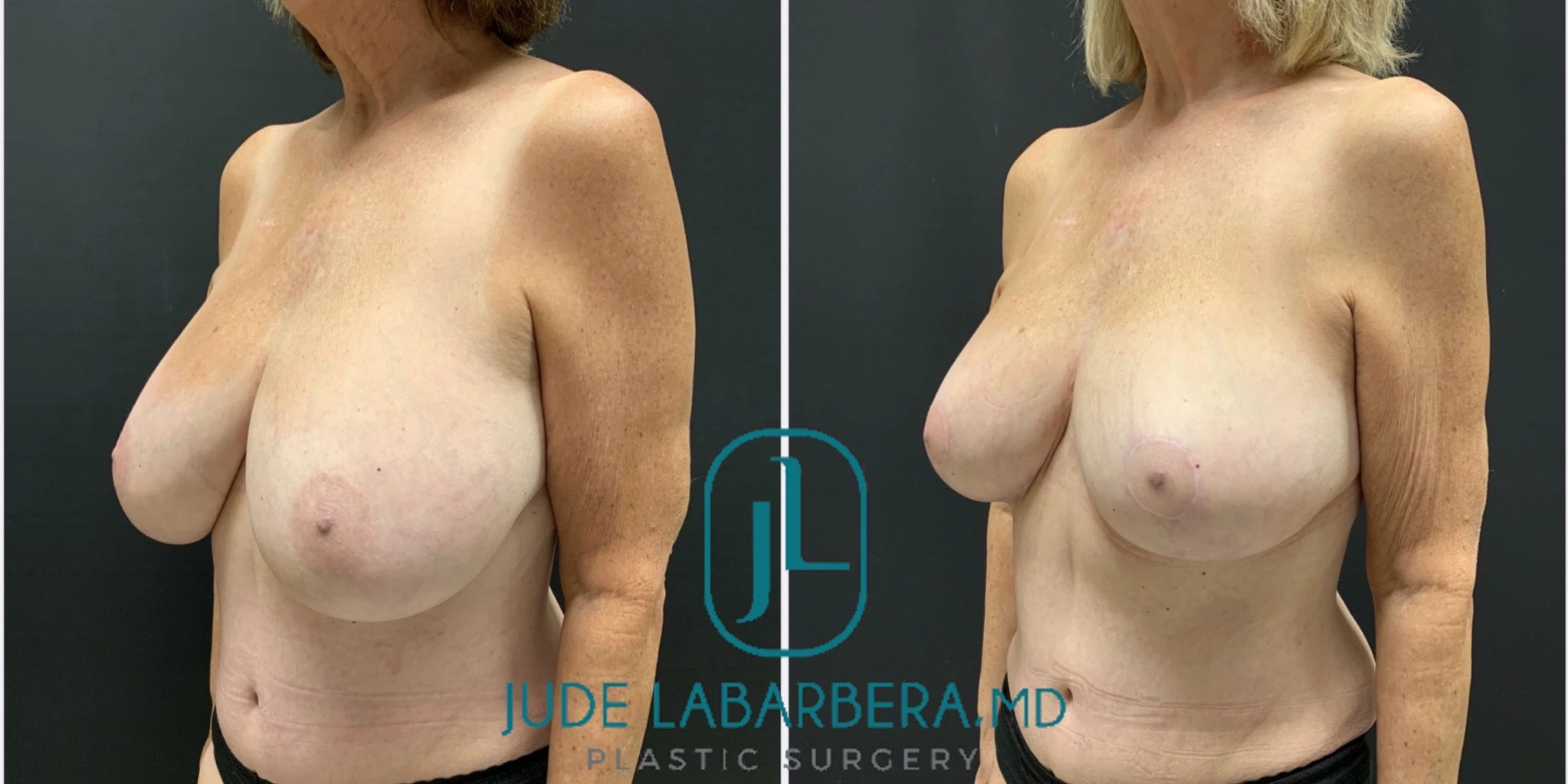 BREAST lift with REDUCTION Before & After Case Number 0009