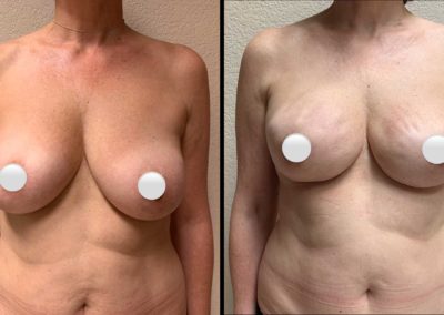 BREAST RECONSTRUCTION Before & After