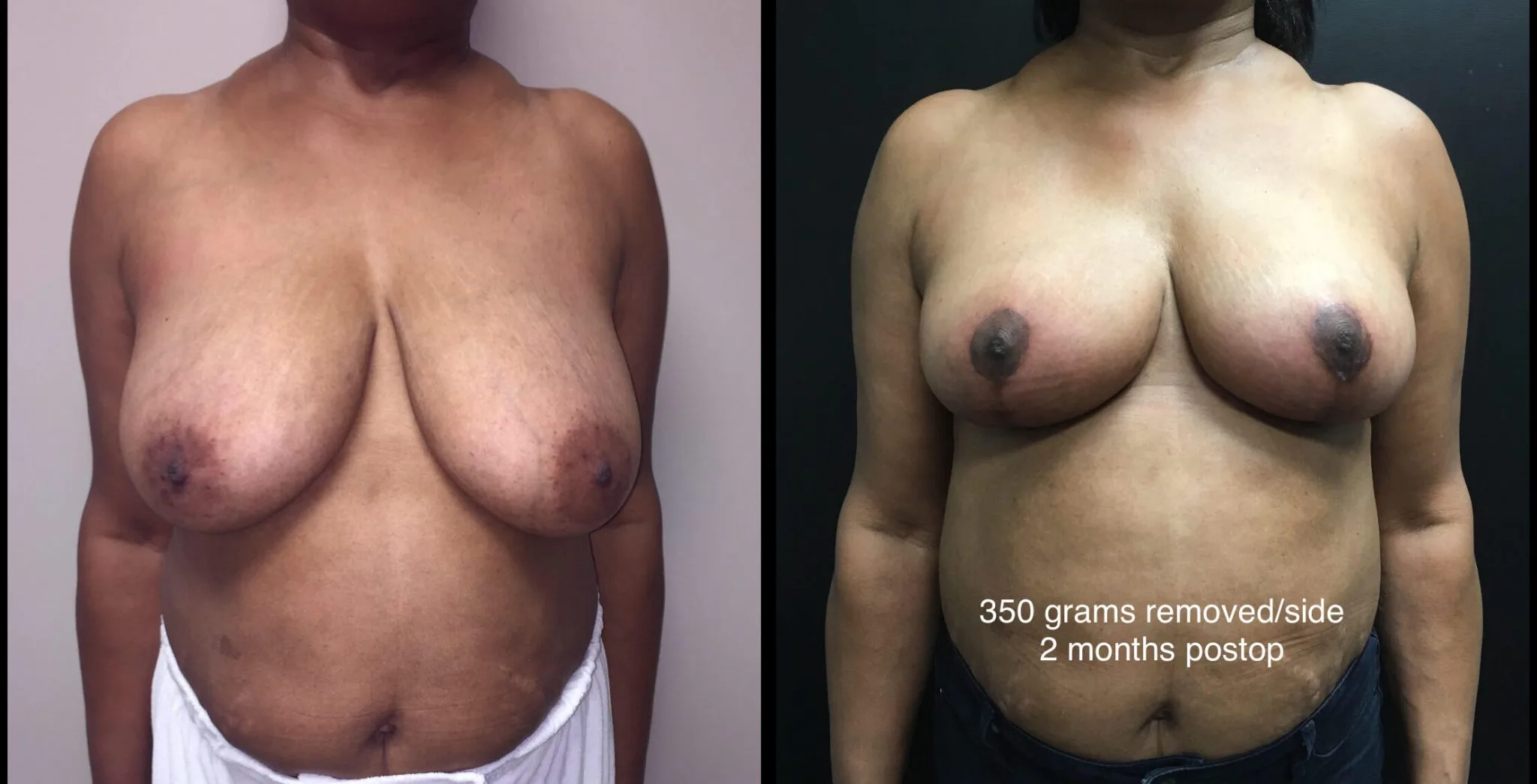 BREAST REDUCTION Before & After case 116