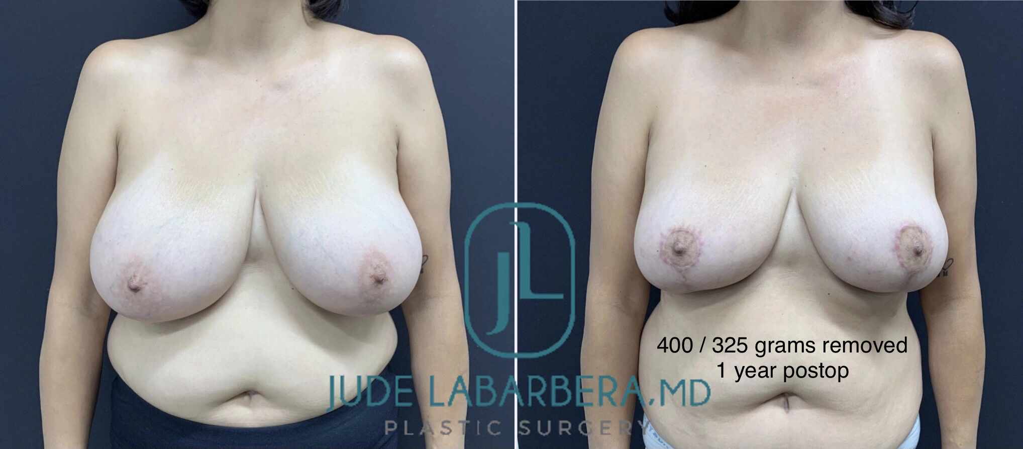 BREAST REDUCTION Before & After case 124