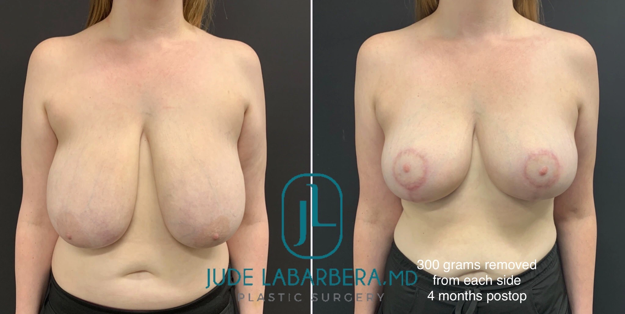 BREAST REDUCTION Before & After Case Number 0002