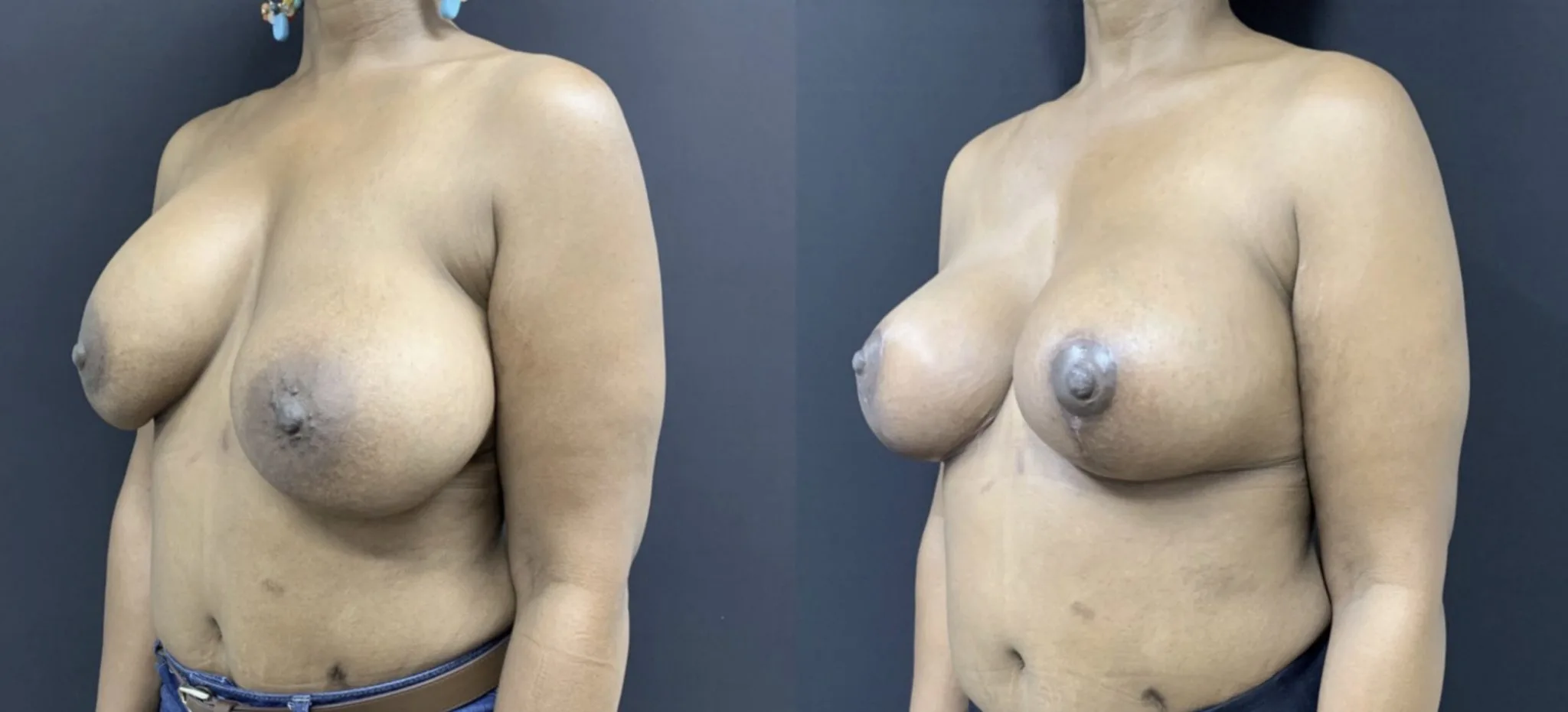 BREAST REVISION Before & After Case Number 0005