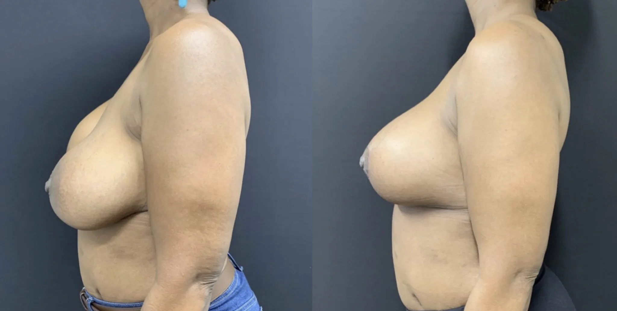 BREAST REVISION Before & After Case Number 0005