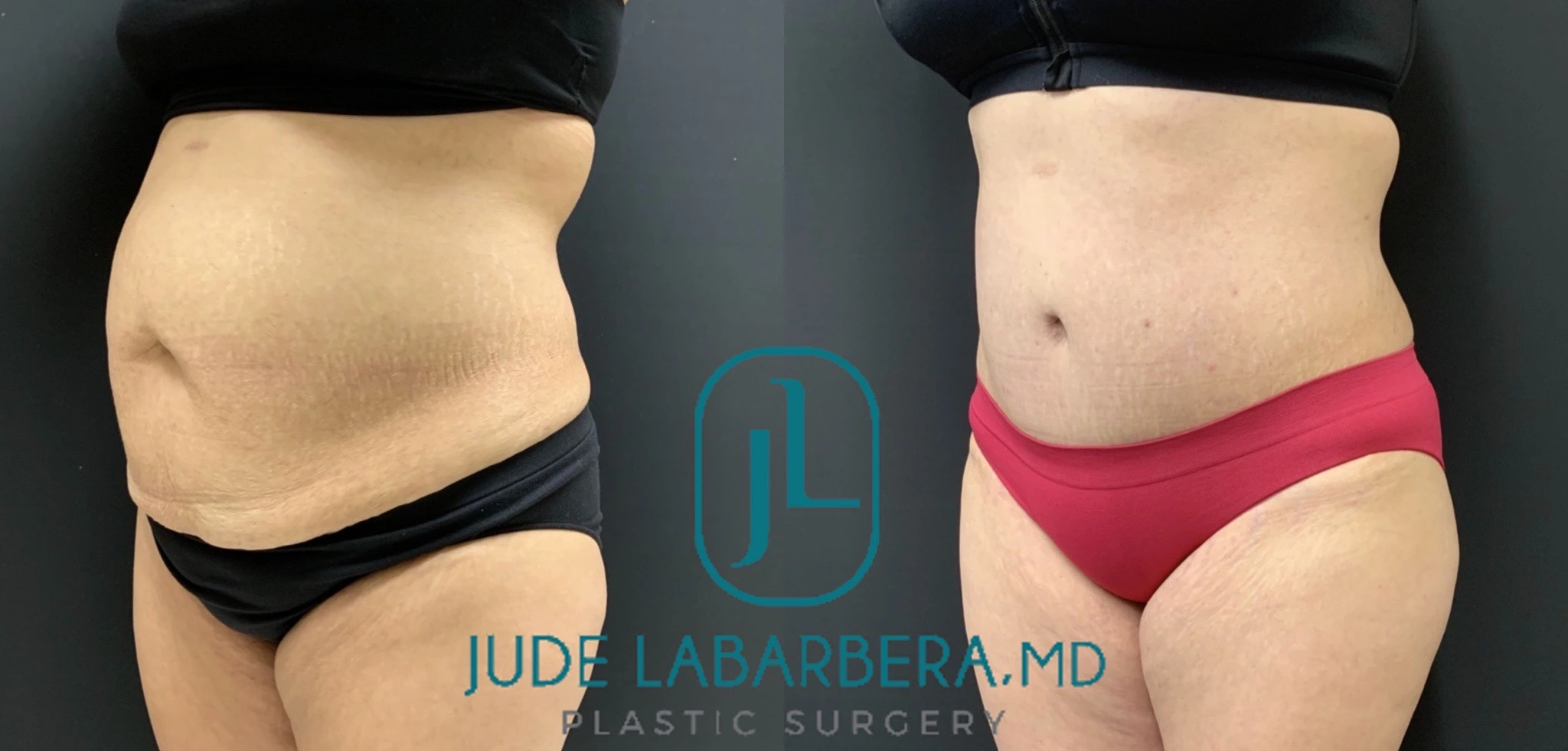Tummy Tuck Before & After Case Number 00012