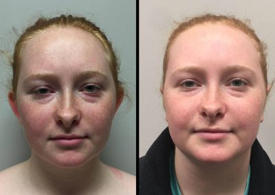 EAR SHAPING & EAR LOBE REPAIR Before & After