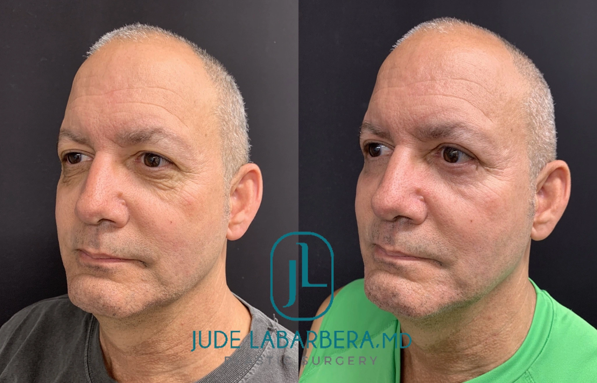 FACELIFT AND LOWER EYELID PROCEDURE Before & After Case Number 00011