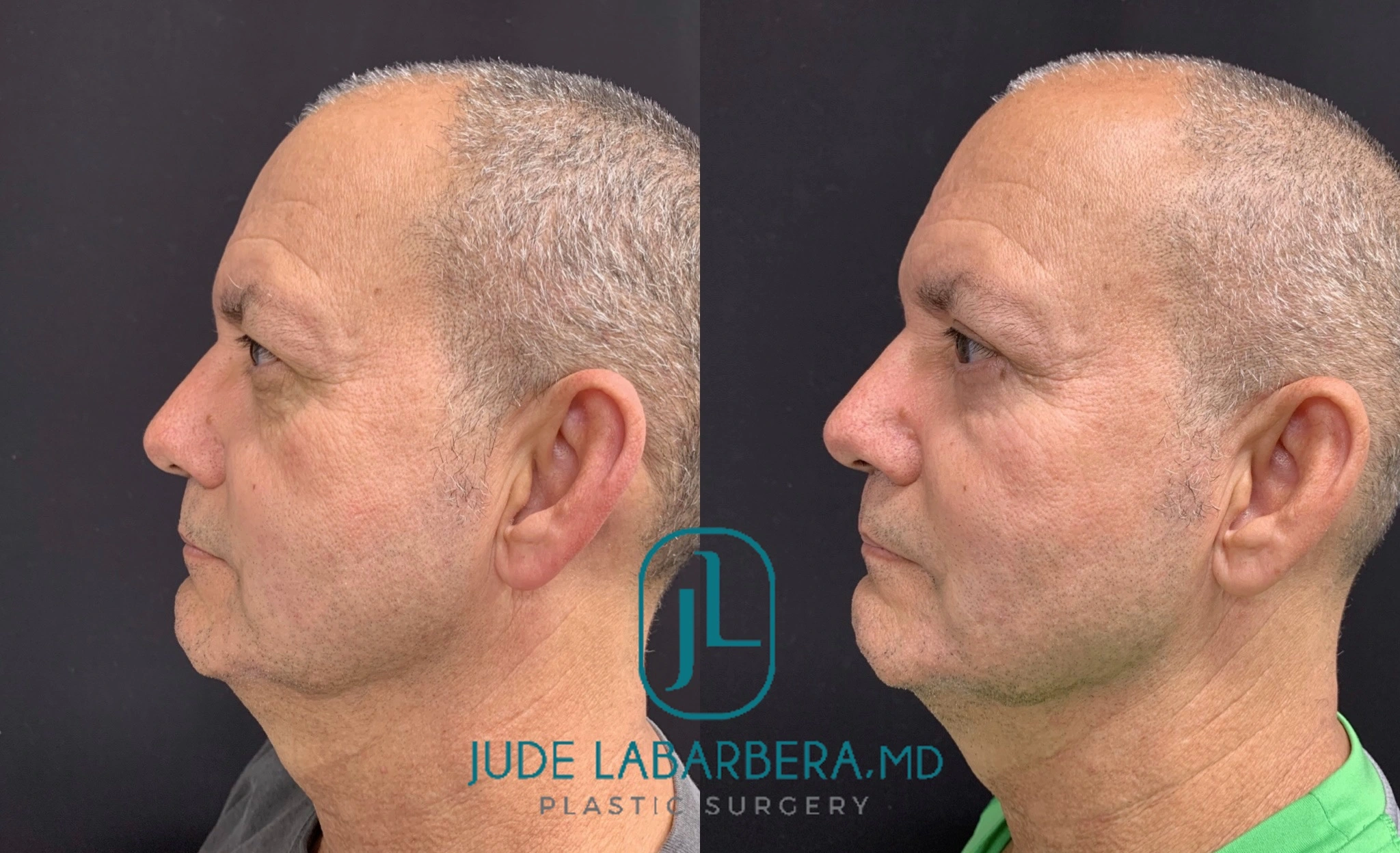 FACELIFT AND LOWER EYELID PROCEDURE Before & After Case Number 00011