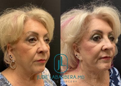 FACELIFT Before & After