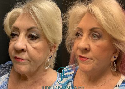 FACELIFT Before & After