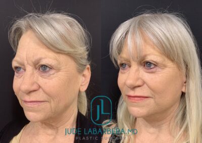 FACELIFT Before & After