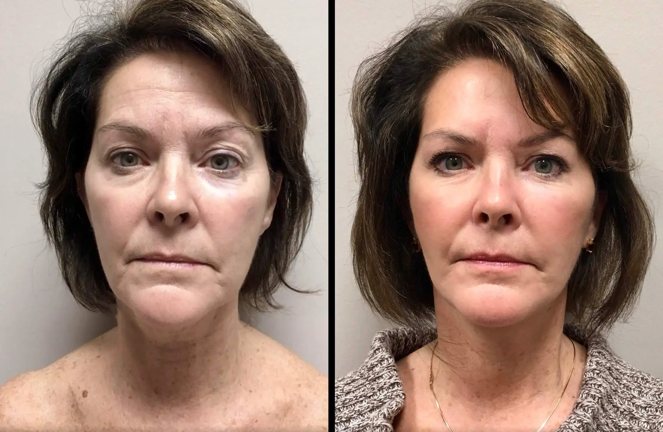 FACELIFT Before & After Case Number 0003