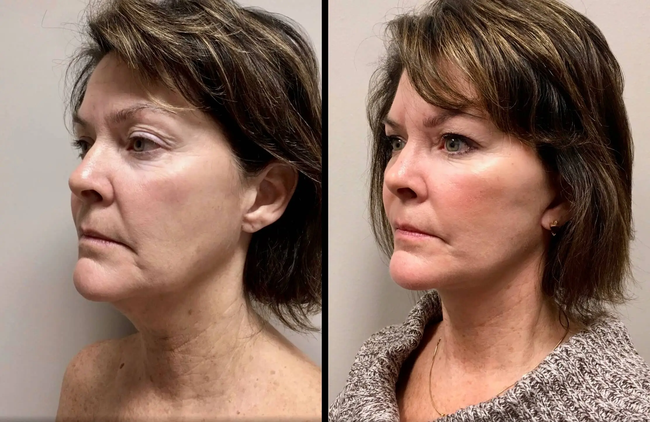 FACELIFT Before & After Case Number 0003