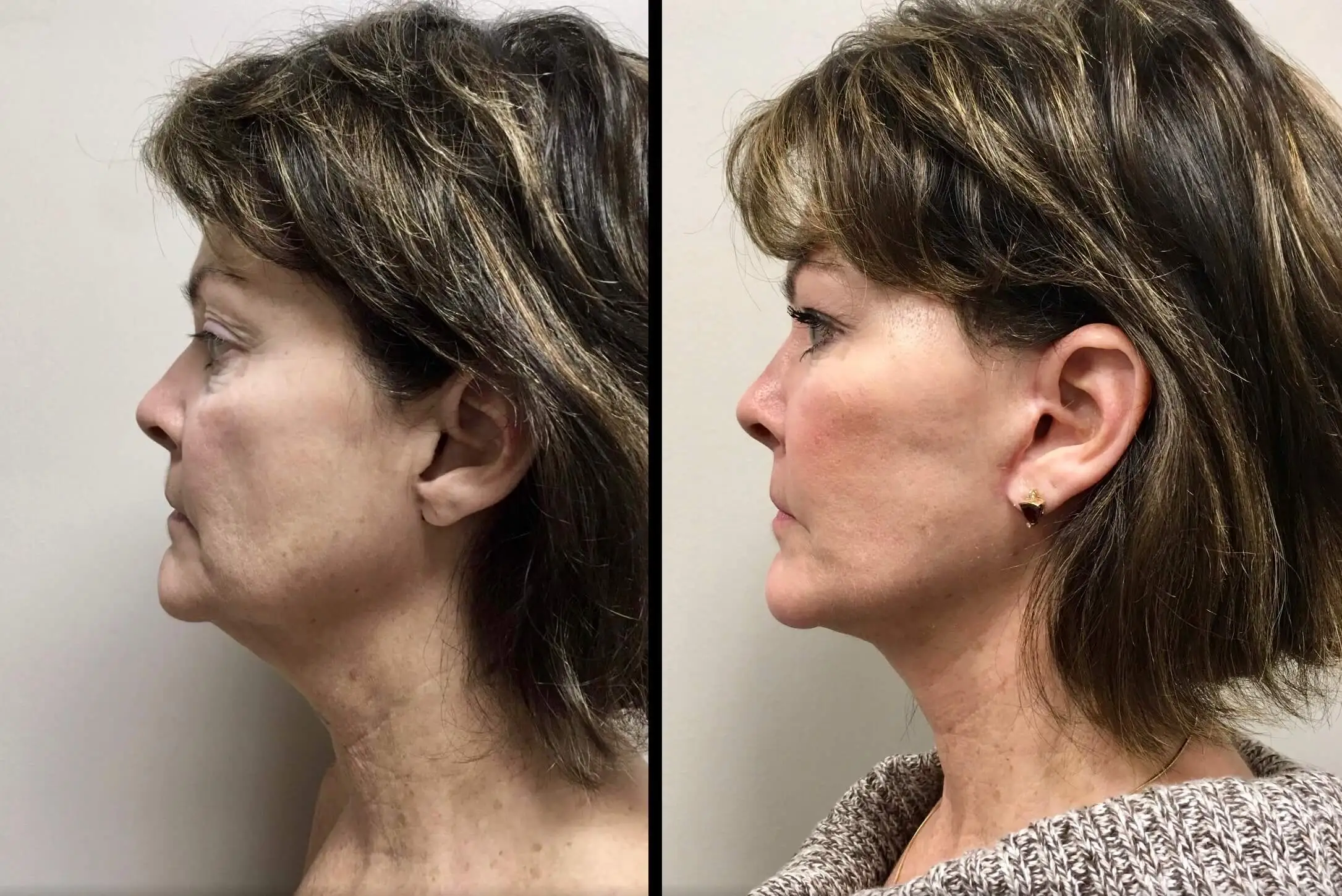 FACELIFT Before & After Case Number 0003