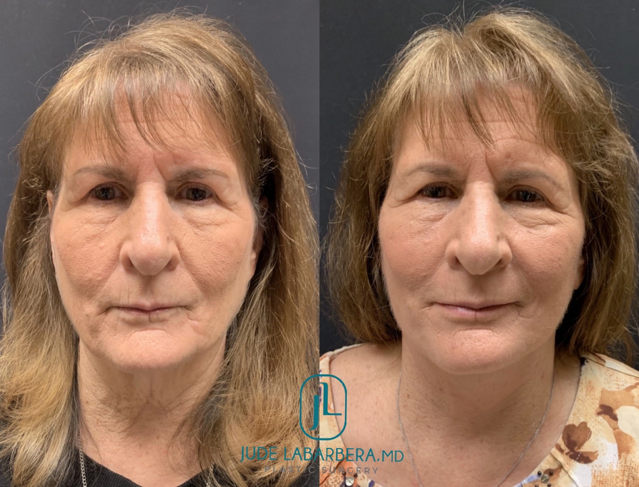 FACELIFT Before & After Case Number 0005