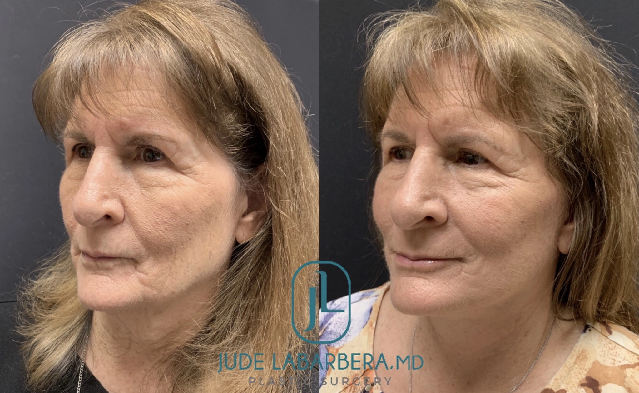 FACELIFT Before & After Case Number 0005