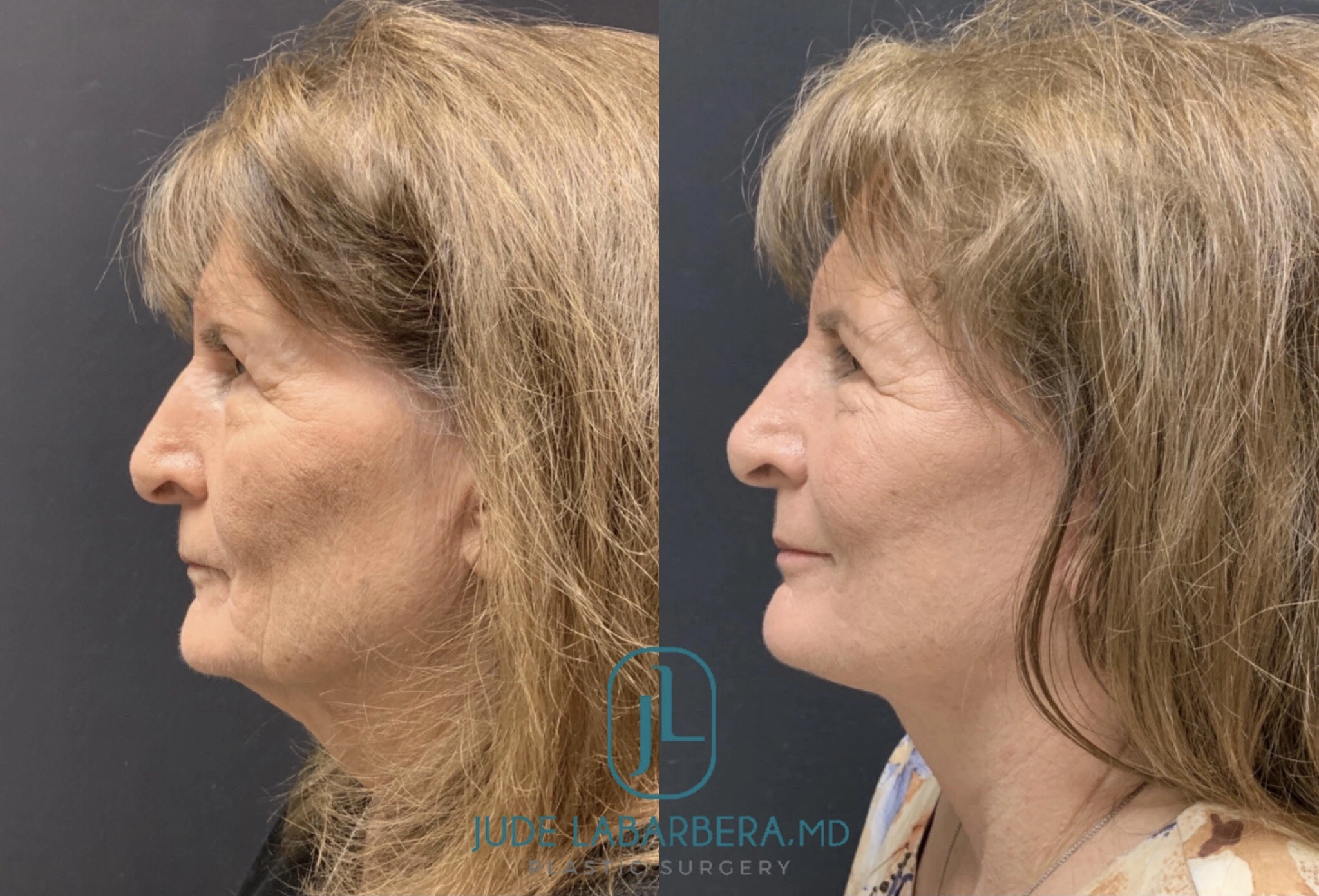 FACELIFT Before & After Case Number 0005