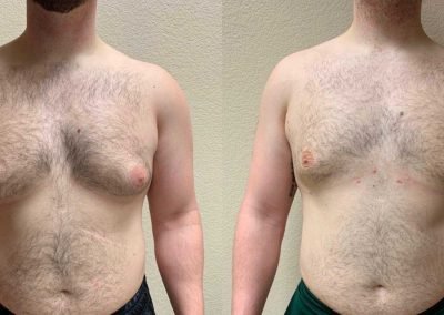 GYNECOMASTIA SURGERY Before & After