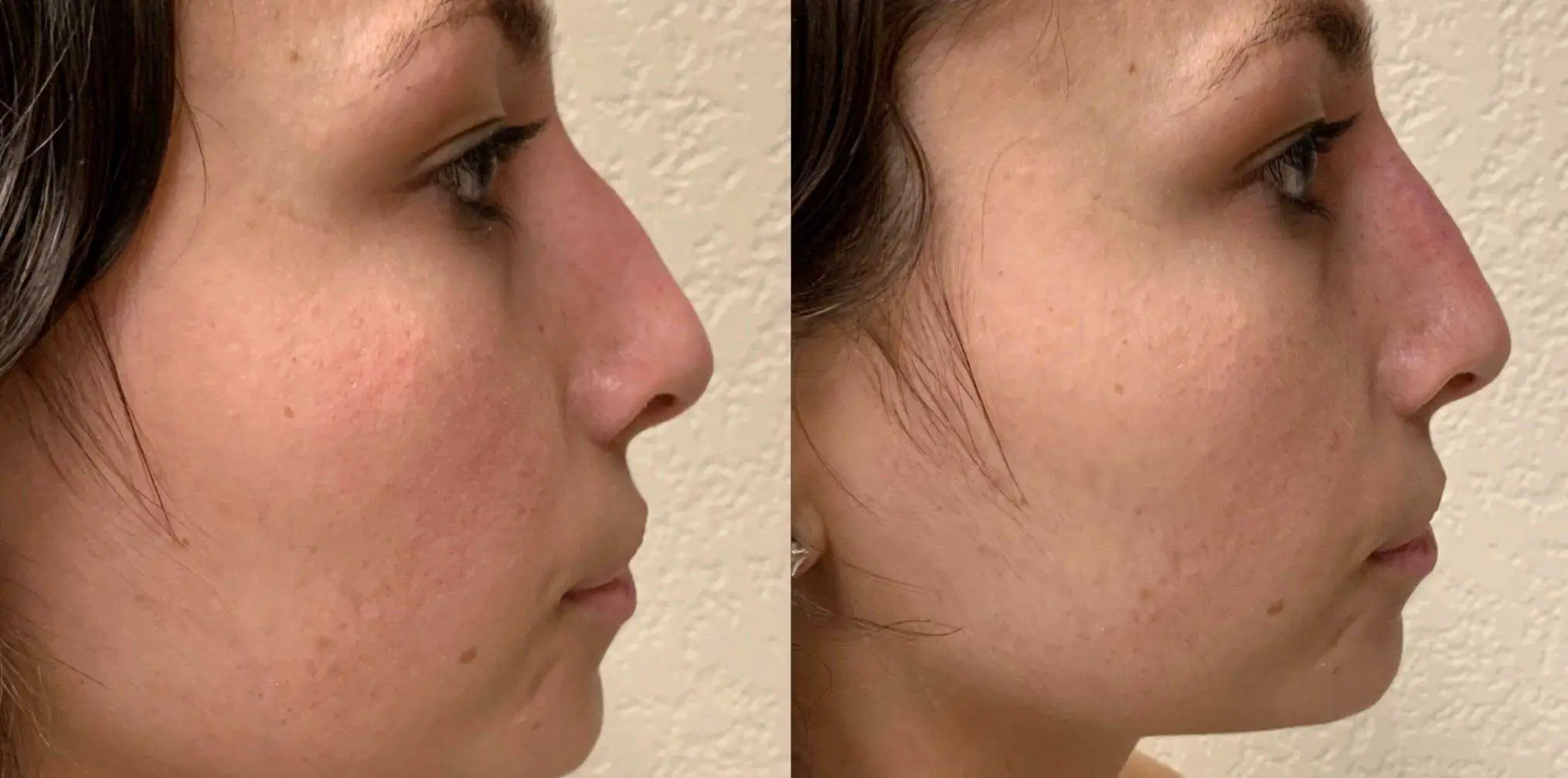 Liquid RHINOPLASTY Before & After Case Number 0001