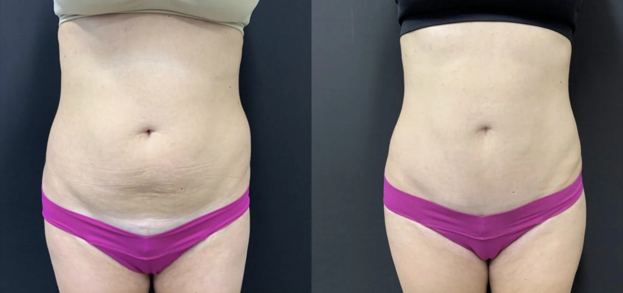 MINI TUMMY TUCK Before & After Case Number 00050