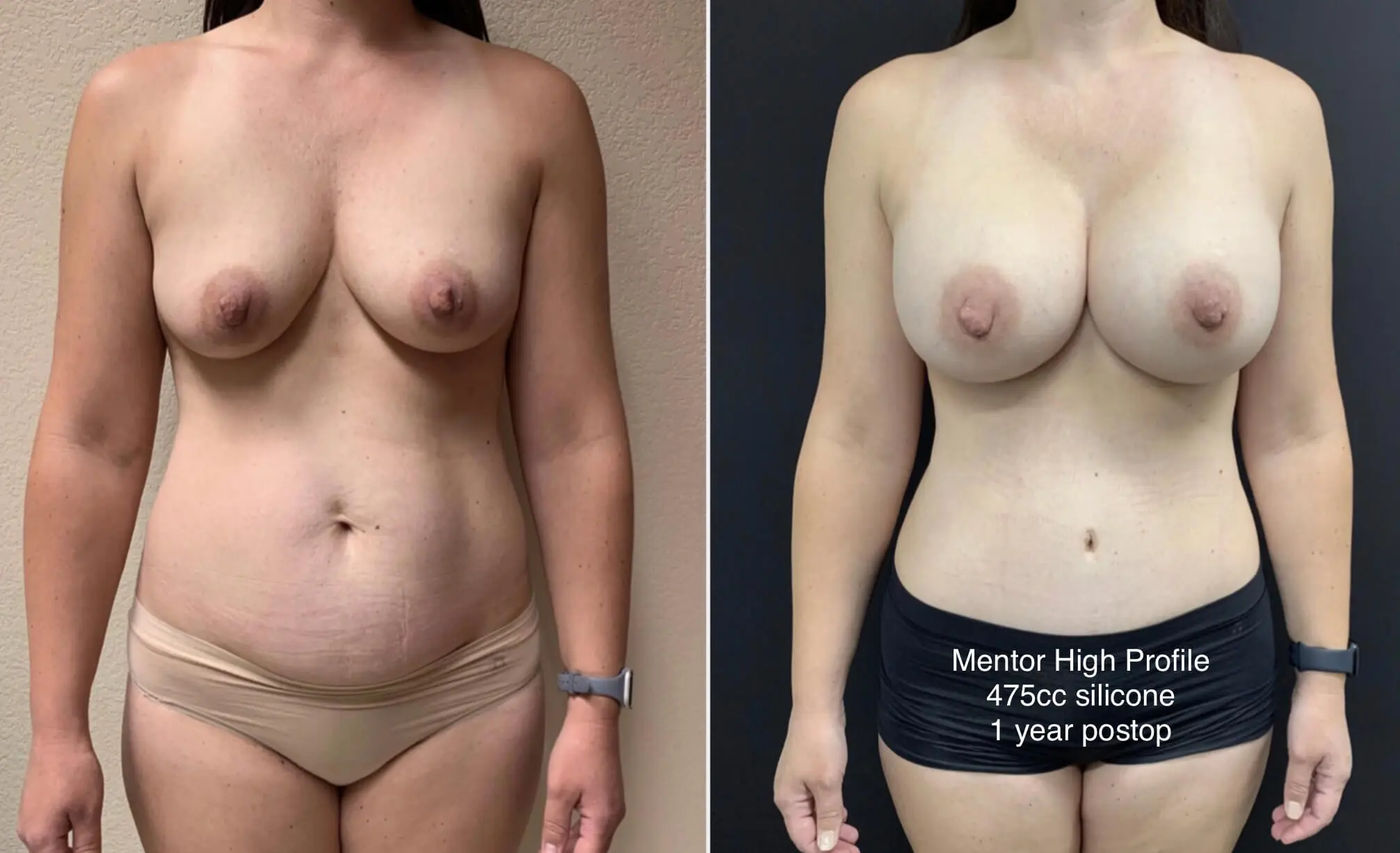 MOMMY MAKEOVER Before & After Case Number 00029