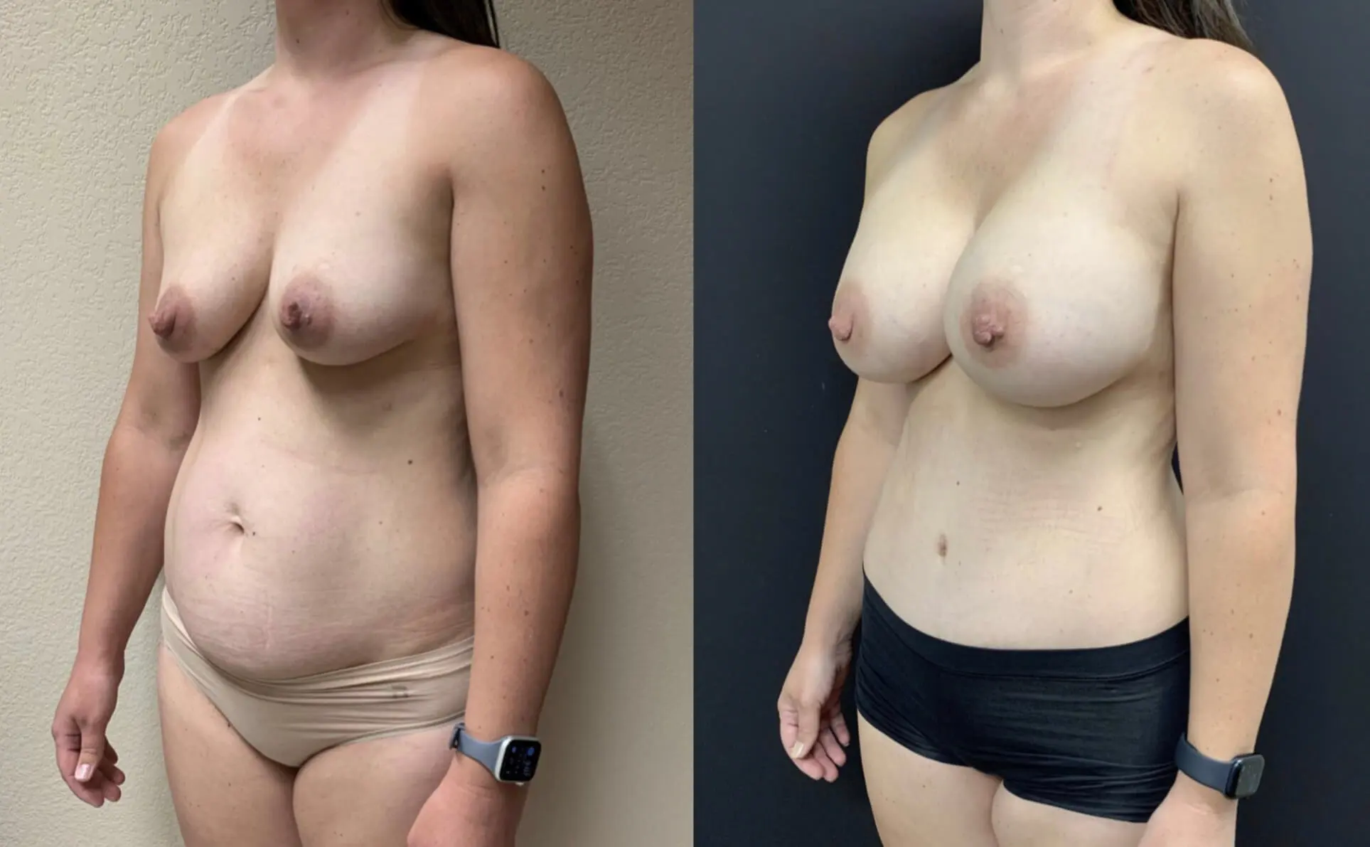 MOMMY MAKEOVER Before & After Case Number 00029