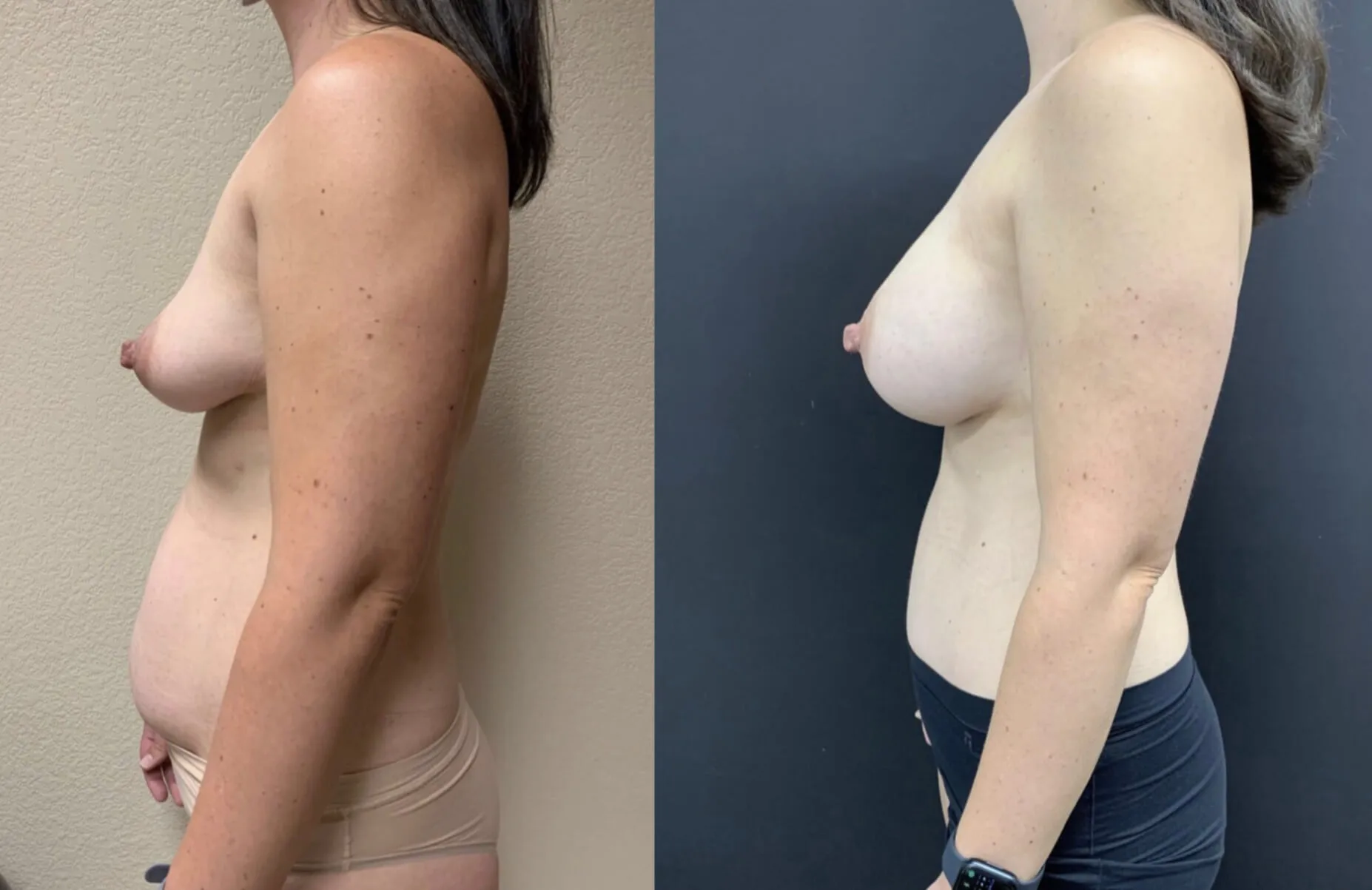 MOMMY MAKEOVER Before & After Case Number 00029