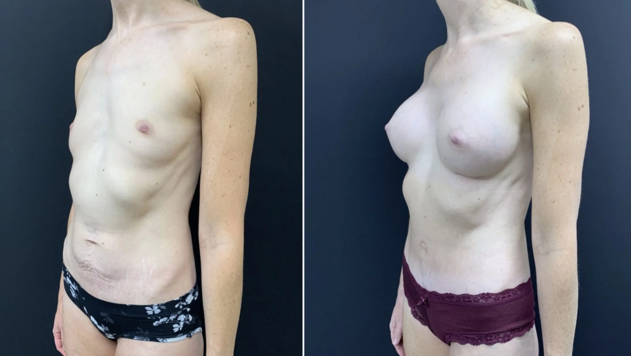MOMMY MAKEOVER Before & After Case Number 0004