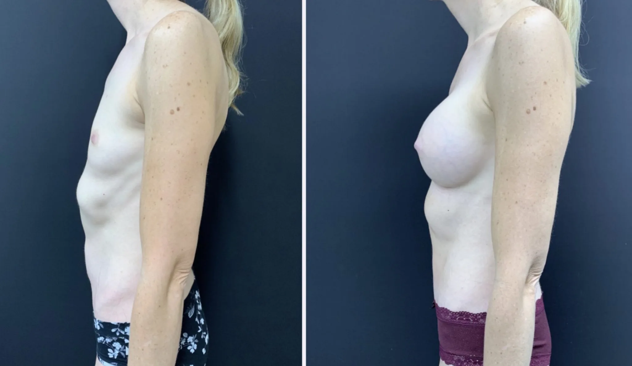 MOMMY MAKEOVER Before & After Case Number 0004