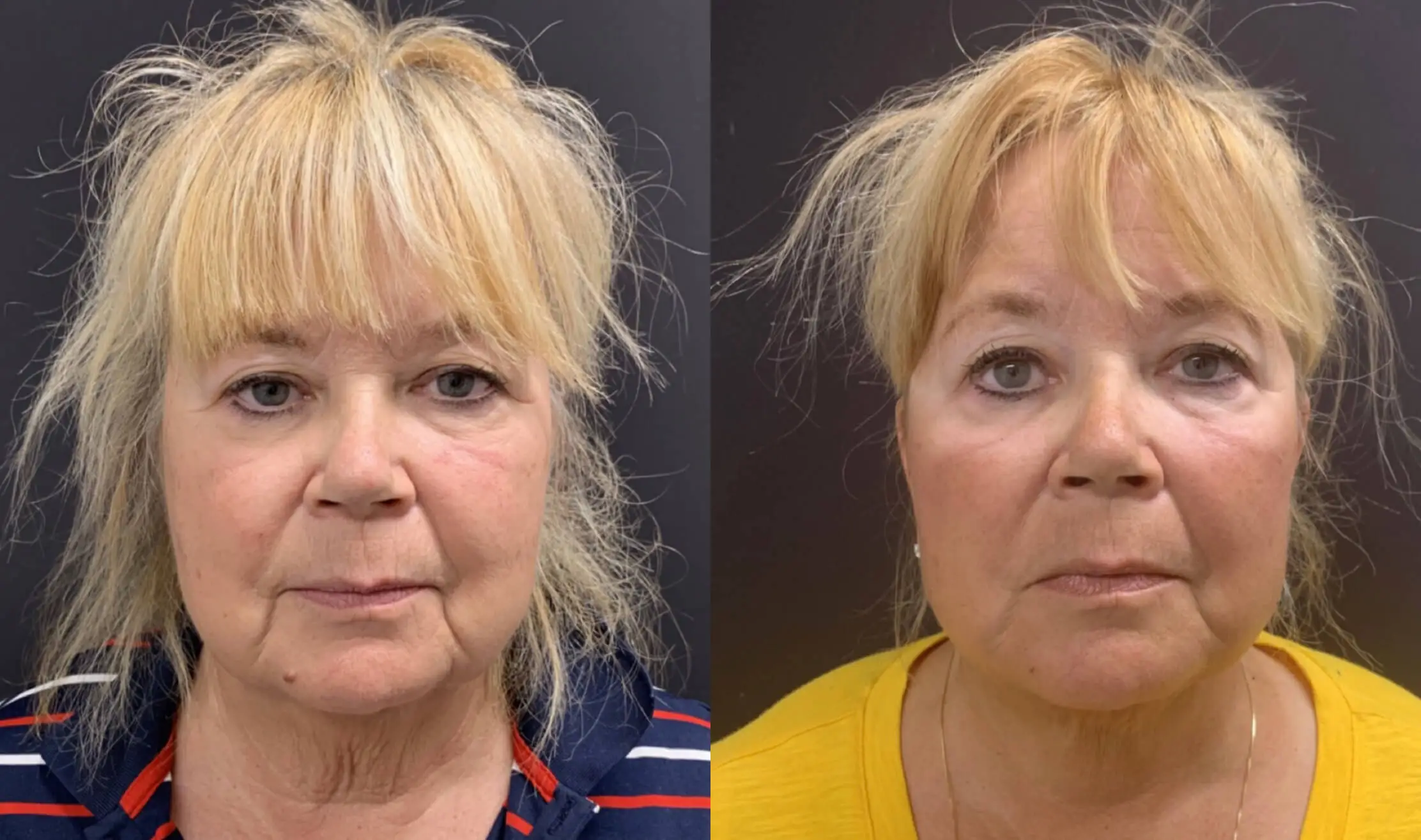 NATURAL FACE AND NECK LIFT Before & After case 3