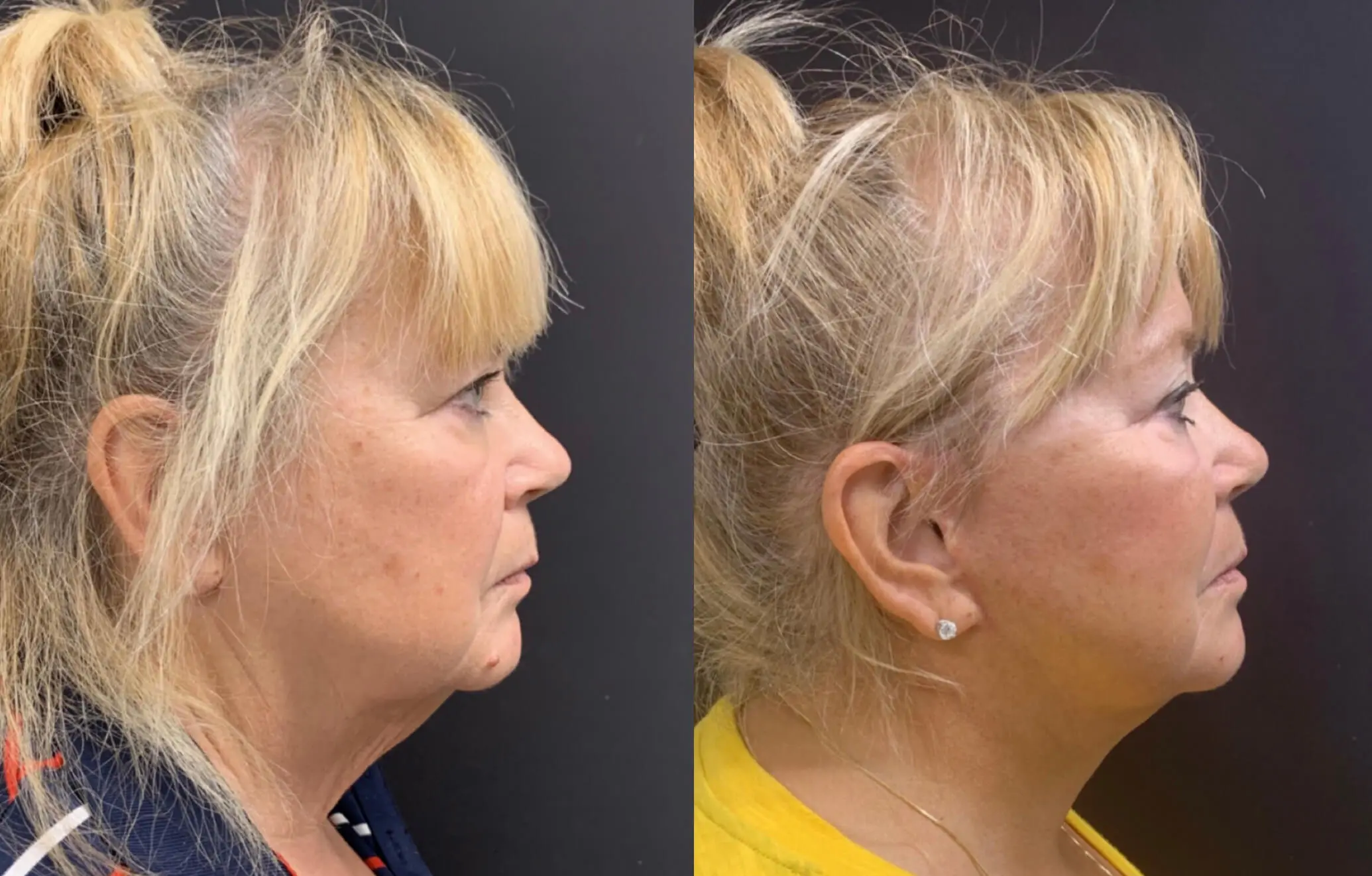 NATURAL FACE AND NECK LIFT Before & After case 3