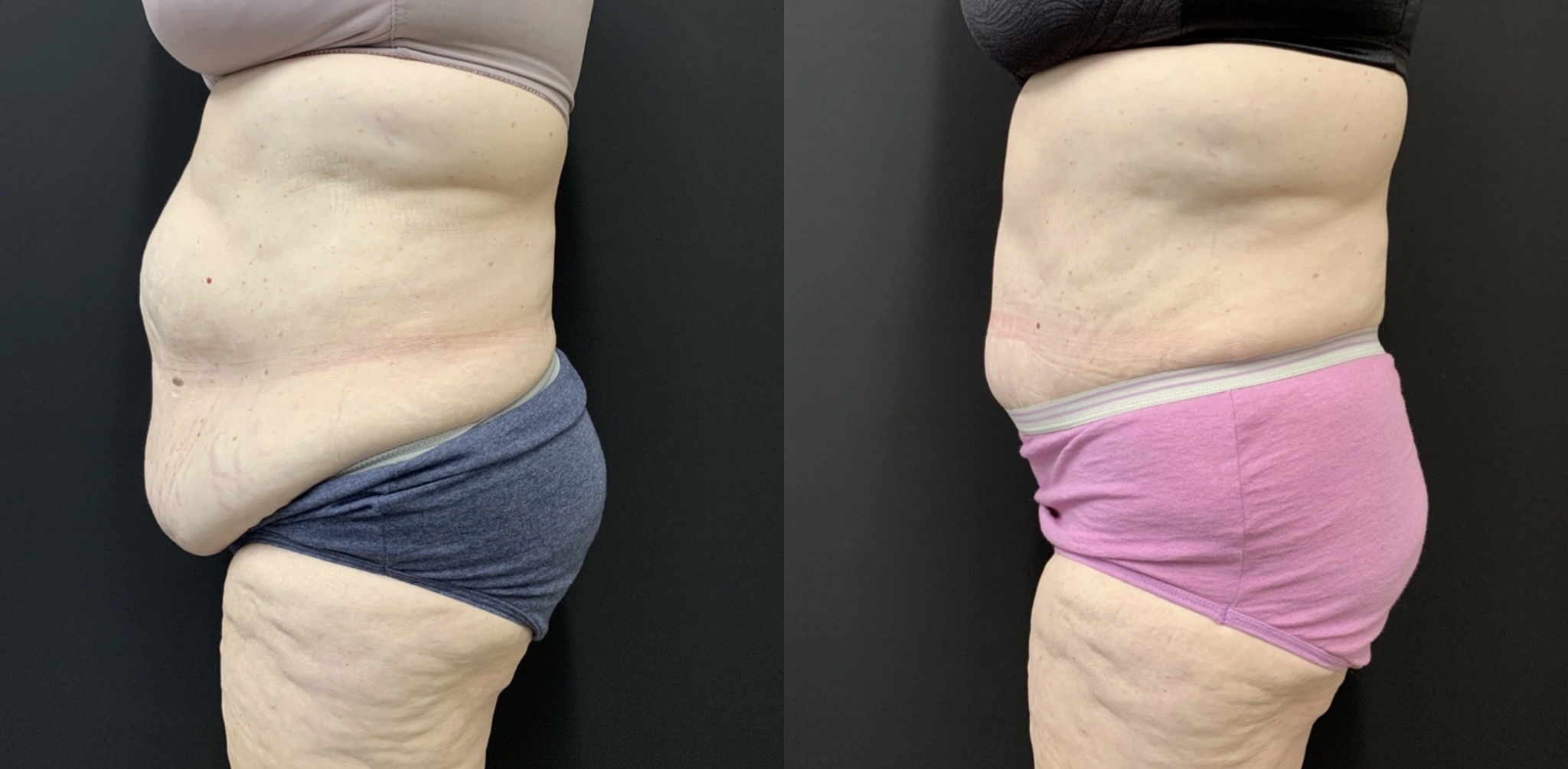 NATURAL Tummy Tuck Before & After Case Number 0005