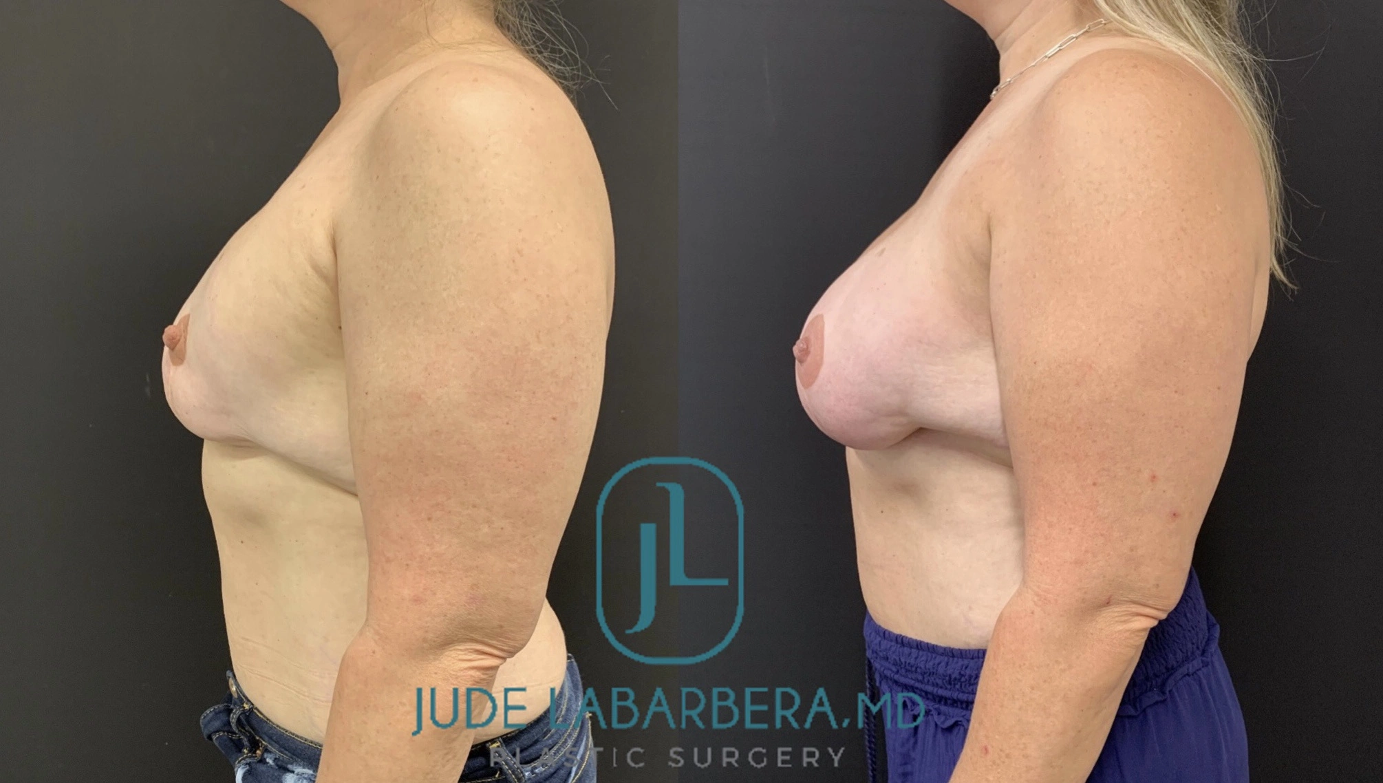 REVISION BREAST SURGERY Before & After Case Number 00010