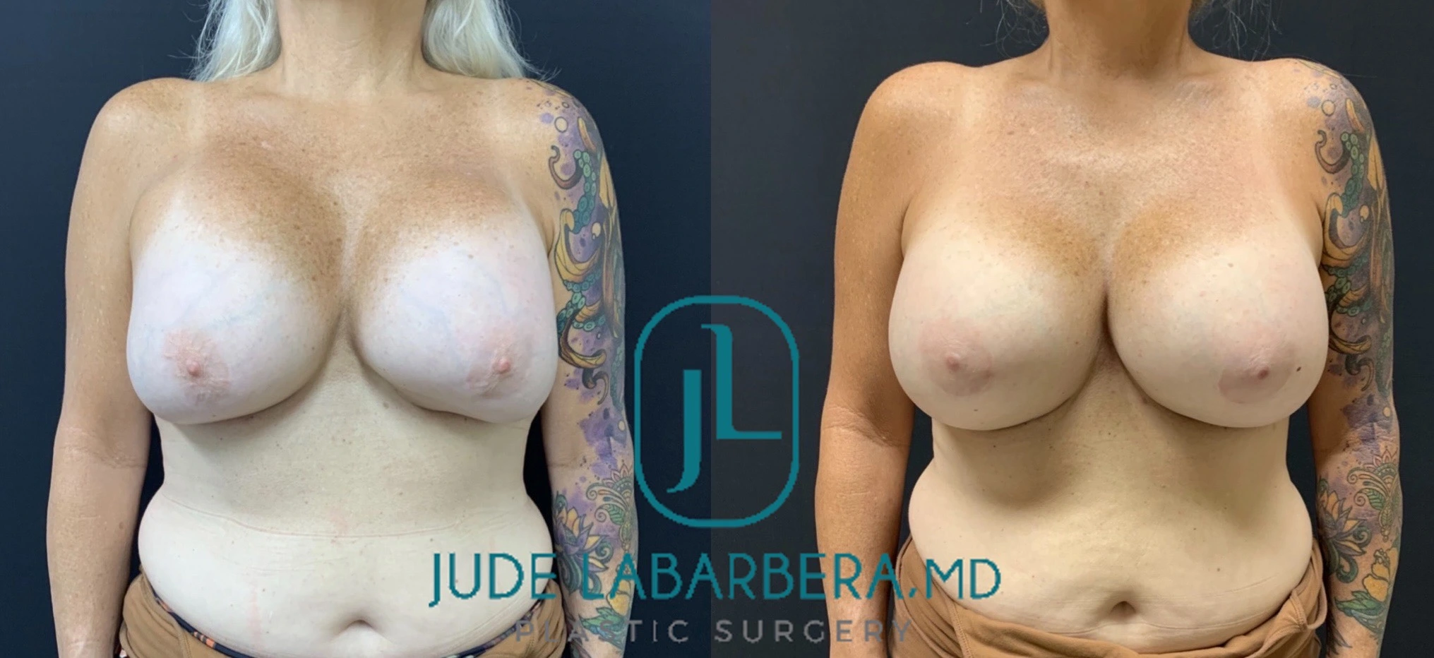 REVISION BREAST SURGERY Before & After Case Number 0009
