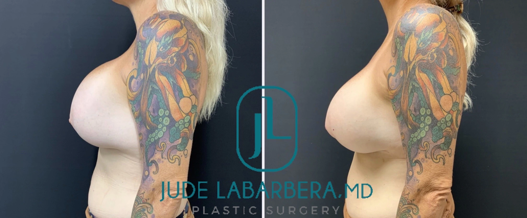 REVISION BREAST SURGERY Before & After Case Number 0009