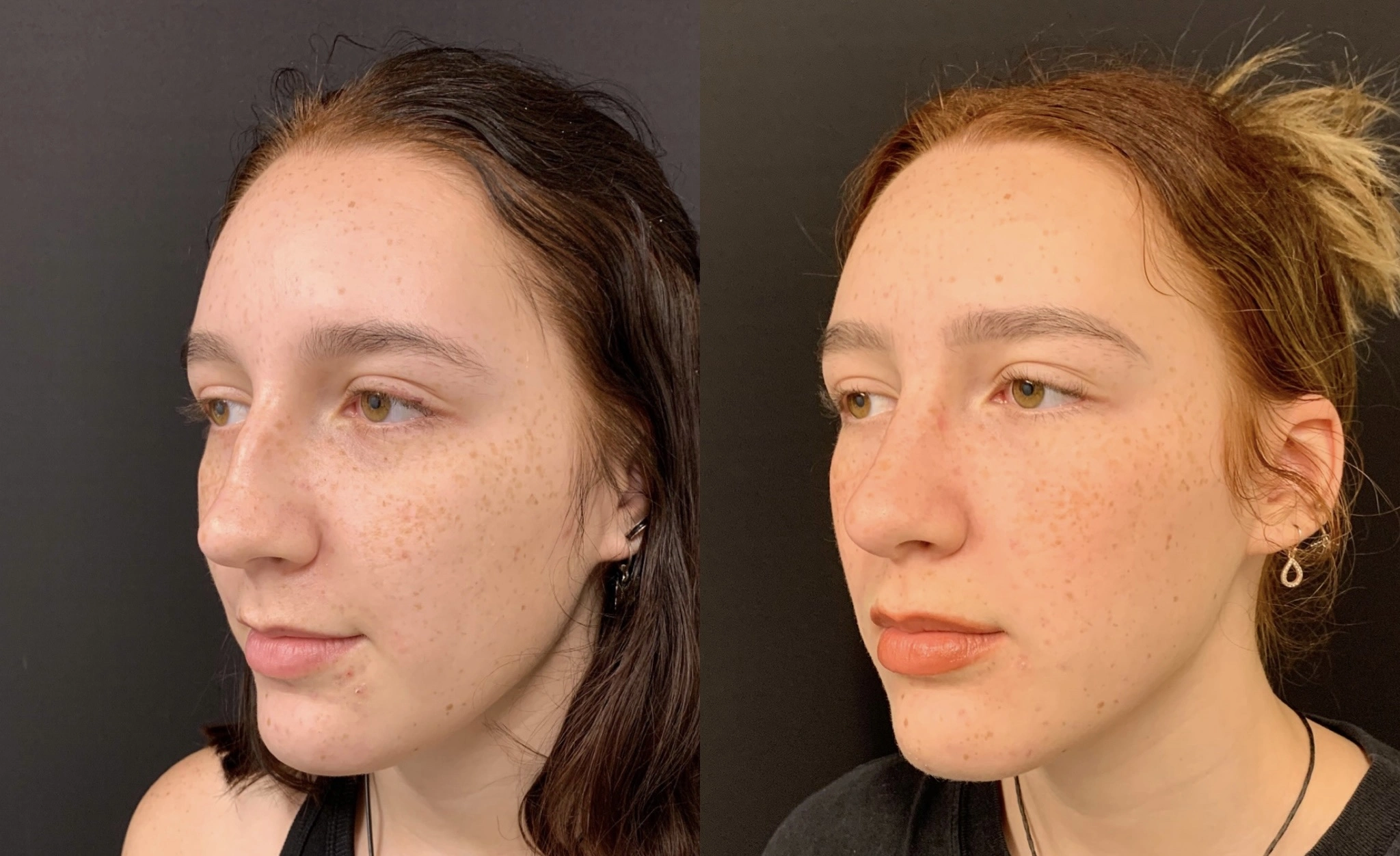 RHINOPLASTY Before & After Case Number 0002