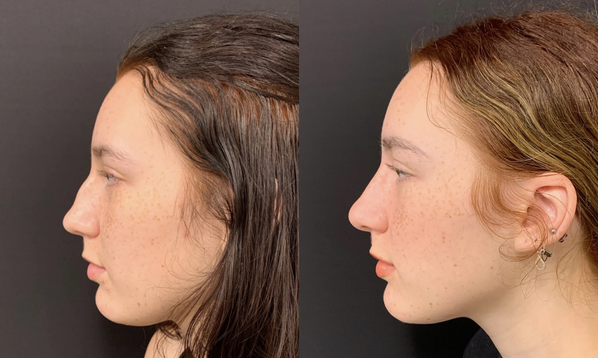 RHINOPLASTY Before & After Case Number 0002