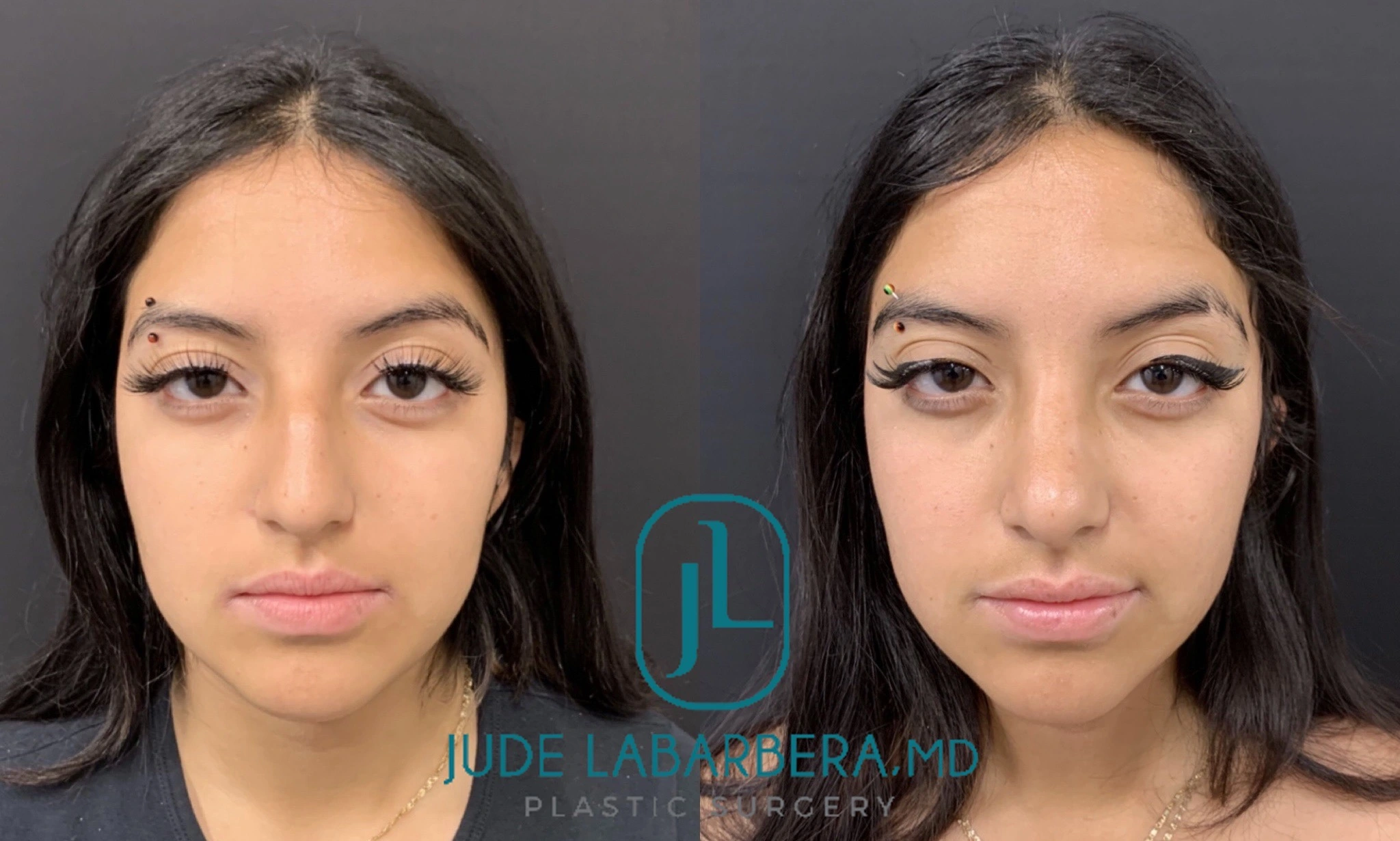 RHINOPLASTY Before & After Case Number 0003