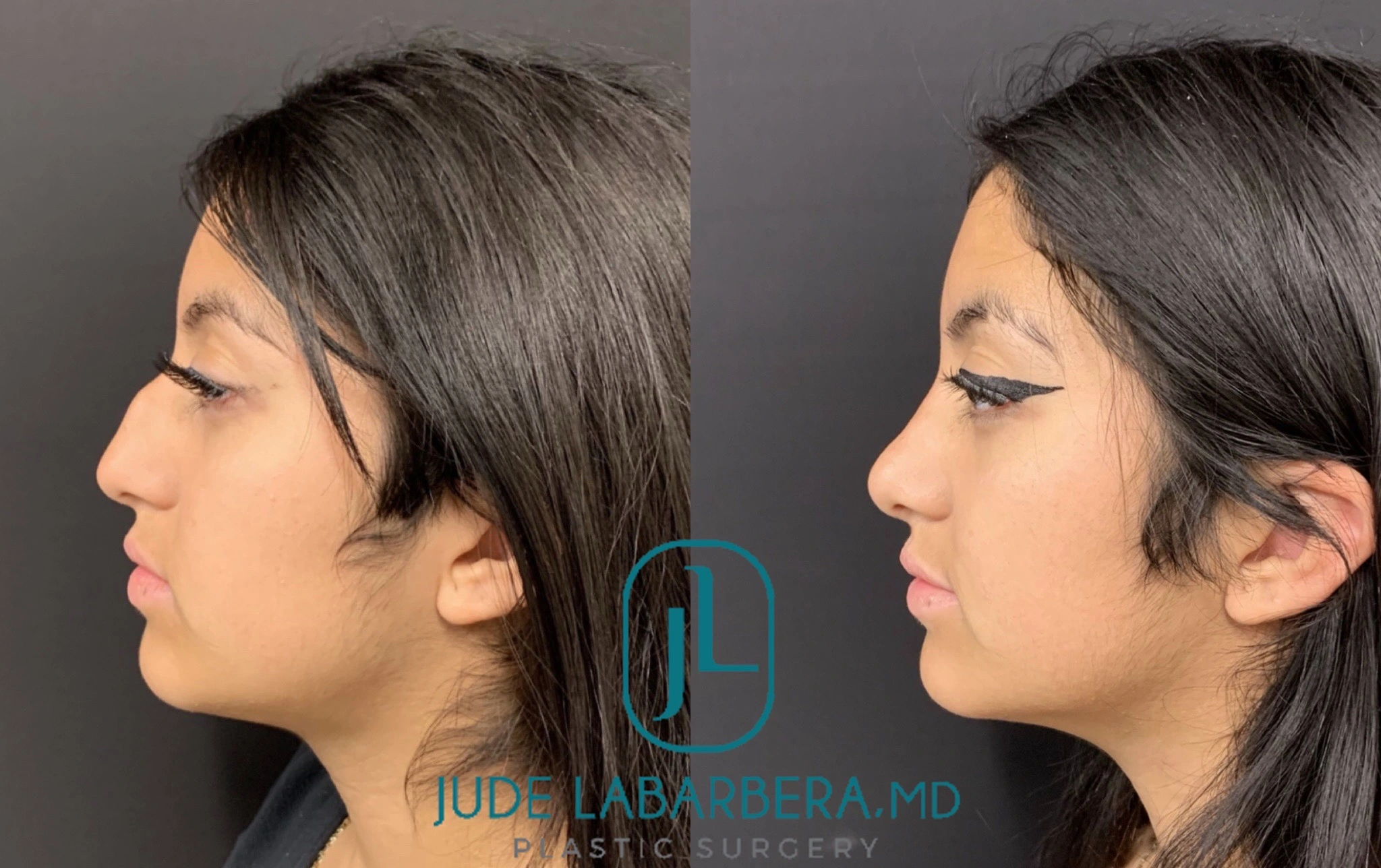 RHINOPLASTY Before & After Case Number 0003