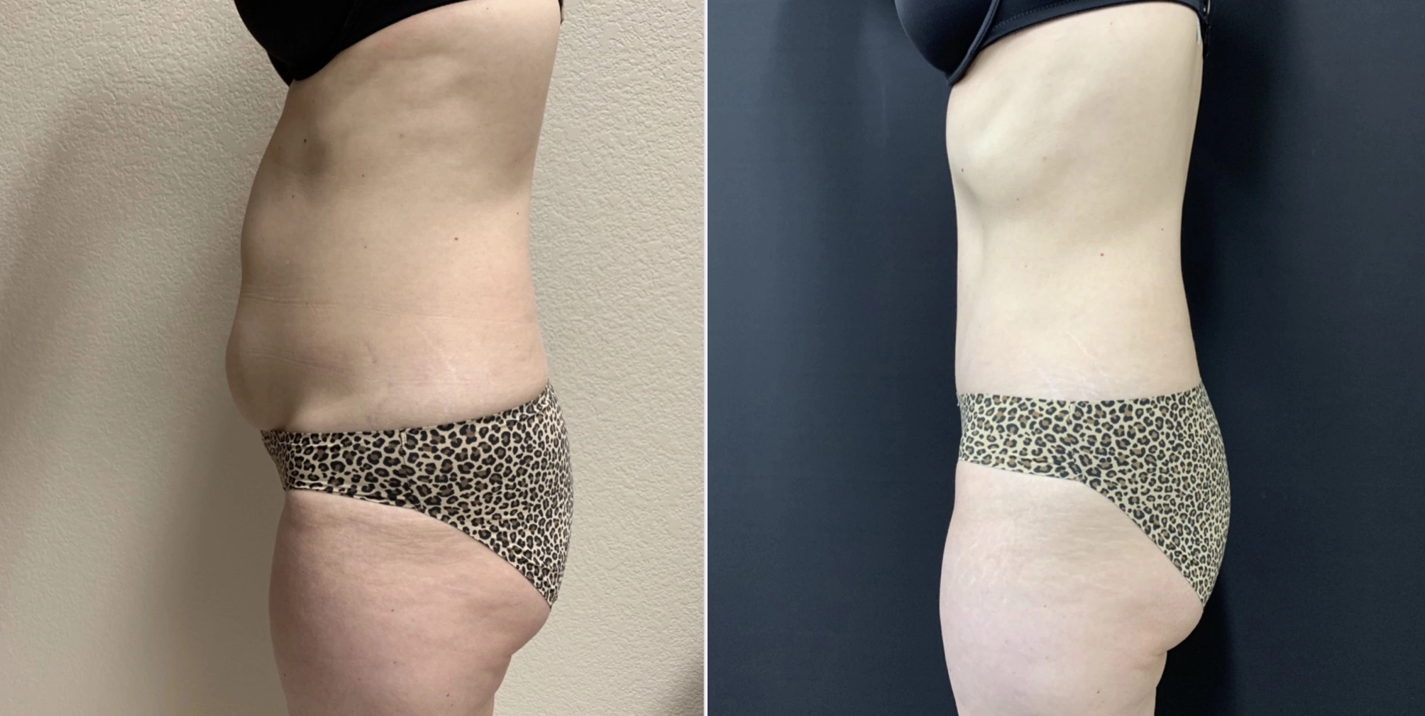 STUNNING TUMMY TUCK Before & After Case Number 000116