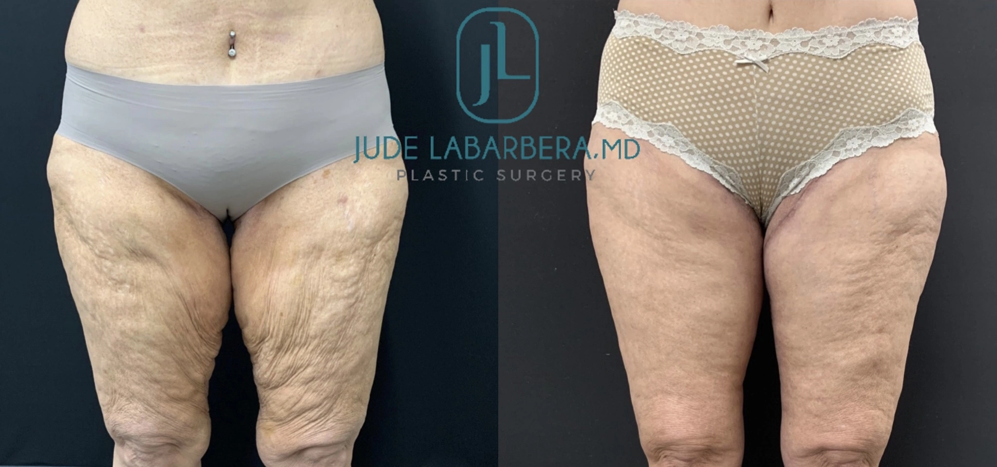 THIGH LIFT Before & After