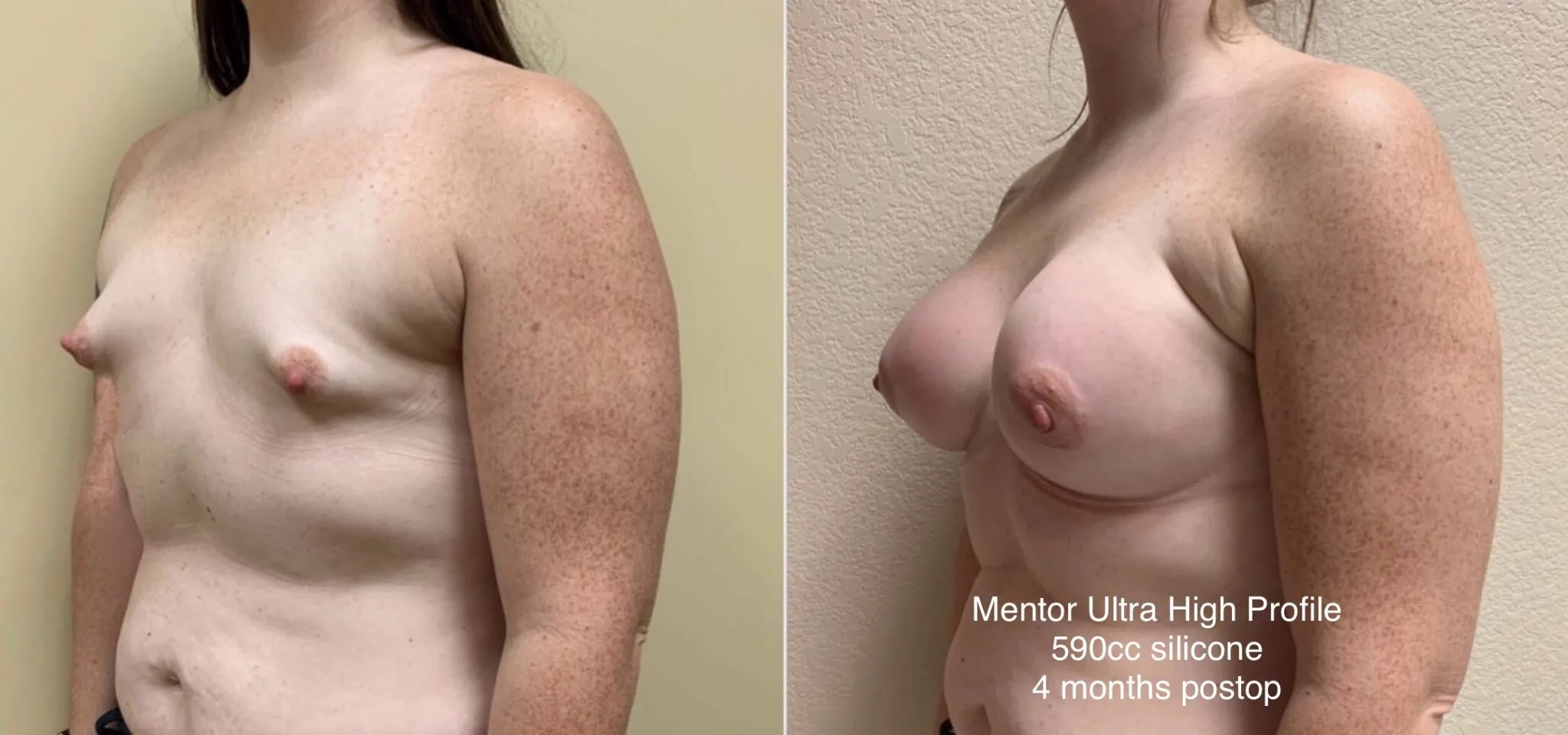 TUBEROUS BREAST AUGMENTATION Before & After Case Number 0001